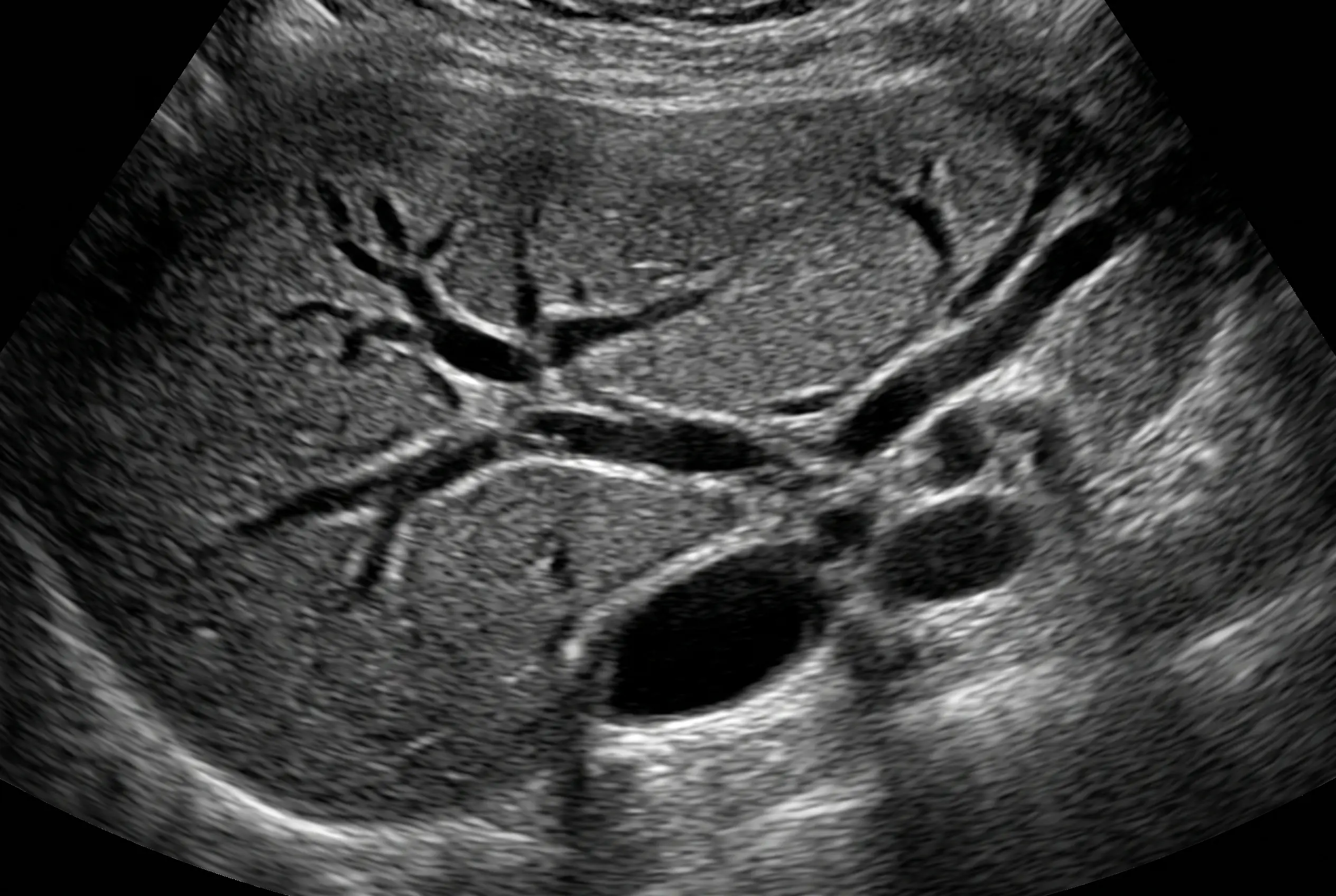 Ultrassonografia abdominal B-mode em janela subcostal mostrando estruturas tubulares anecoicas ramificadas paralelas aos ramos portais e dilatação da via biliar proximal.