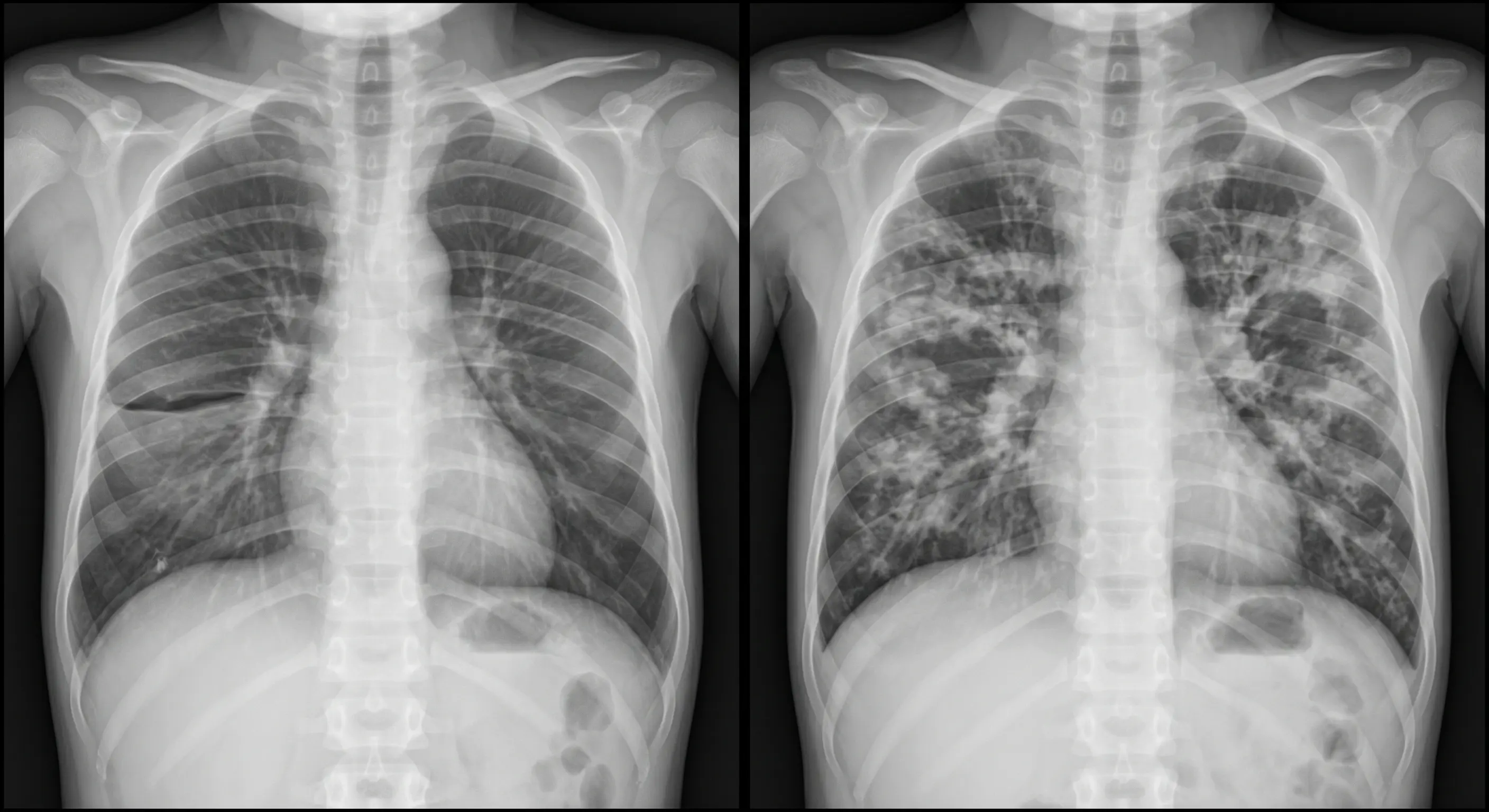 Radiografia PA e tomografia axial de tórax com opacidades bilaterais simétricas peri-hilares e extensas áreas em vidro fosco, sem derrame pleural.
