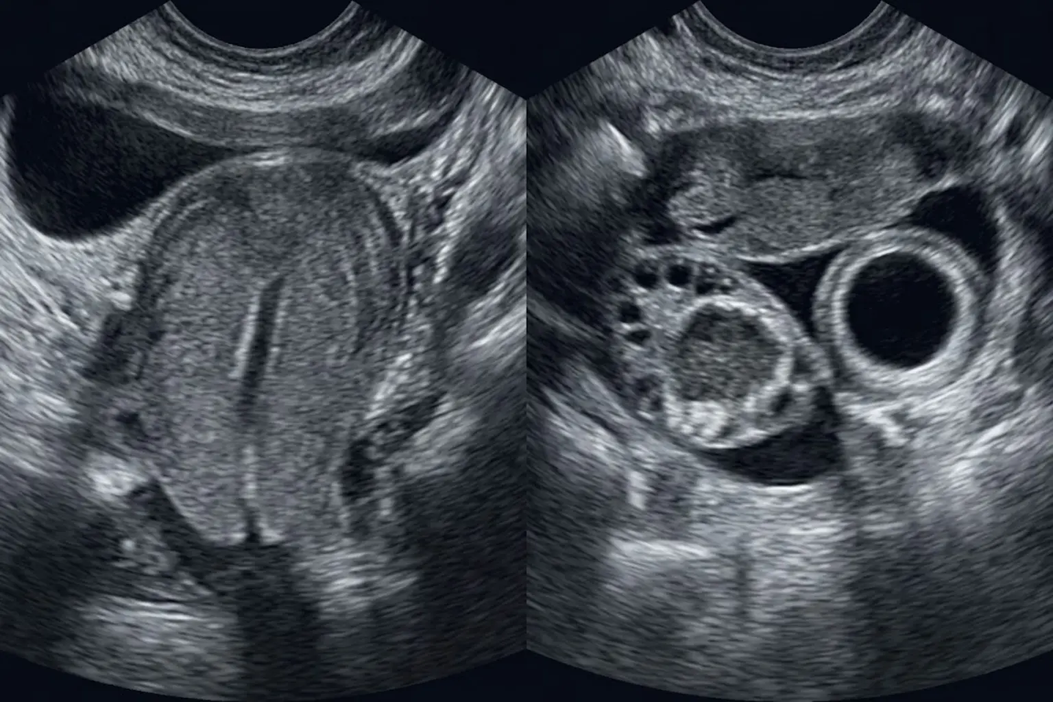 Corte esquemático da pelve: útero com cavidade endometrial vazia; na tuba direita, estrutura arredondada de centro anecoico circundada por anel espesso e brilhante, separada por um intervalo visível do ovário direito, que contém o corpo lúteo; pequena lâmina de líquido livre no fundo de saco.