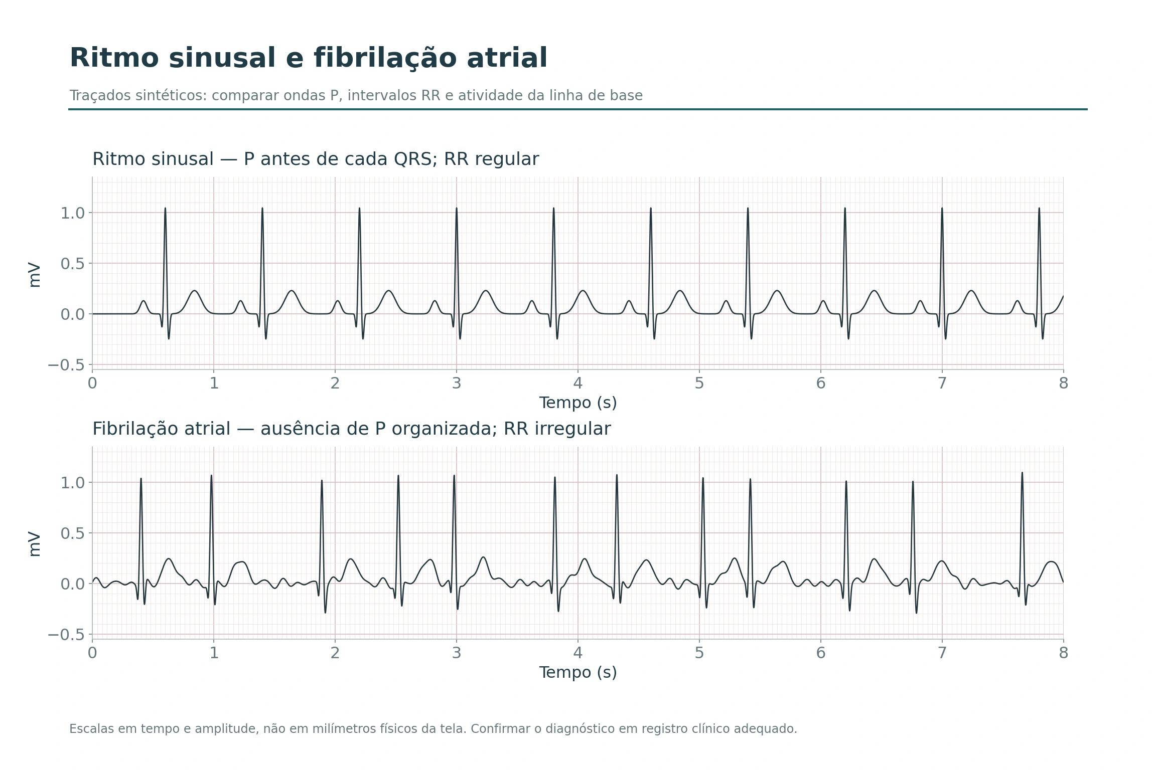 Traçados sintéticos comparando ritmo sinusal regular com fibrilação atrial e intervalos RR irregulares.