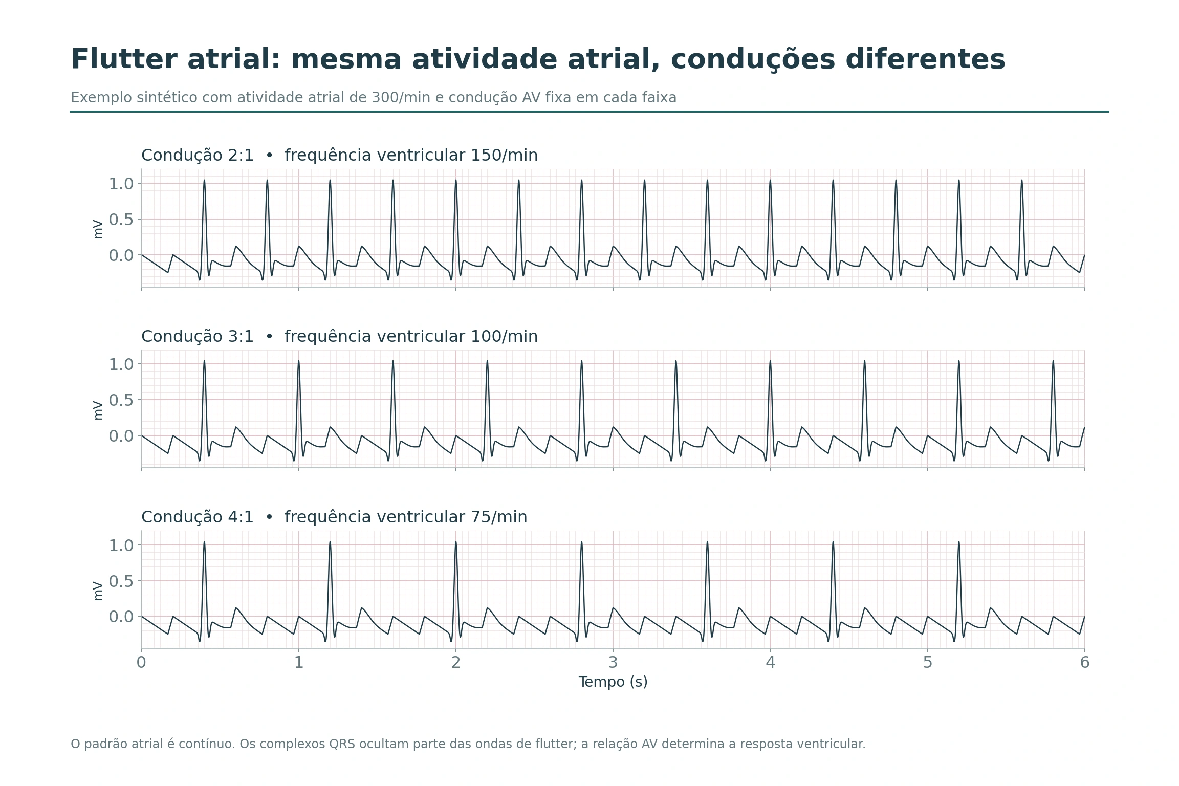 Três traçados sintéticos de flutter a 300 impulsos atriais por minuto com conduções AV 2:1, 3:1 e 4:1.