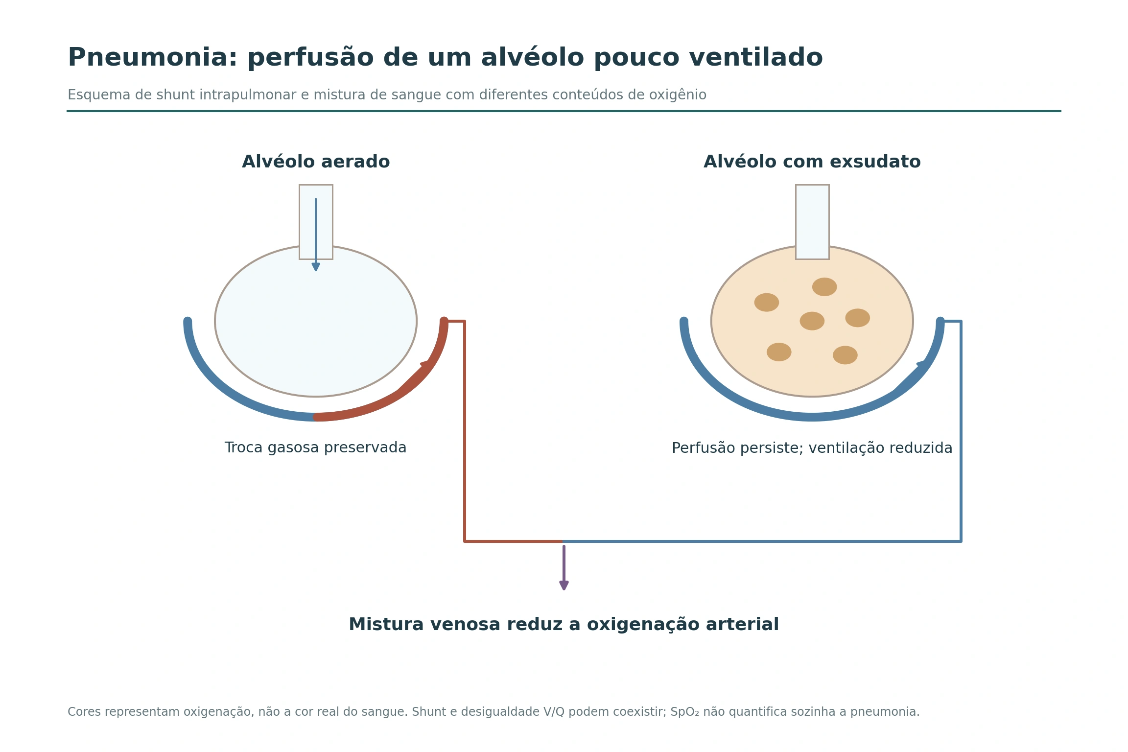 Alvéolo aerado e alvéolo com exsudato, ambos perfundidos, com mistura de sangue de diferentes conteúdos de oxigênio.