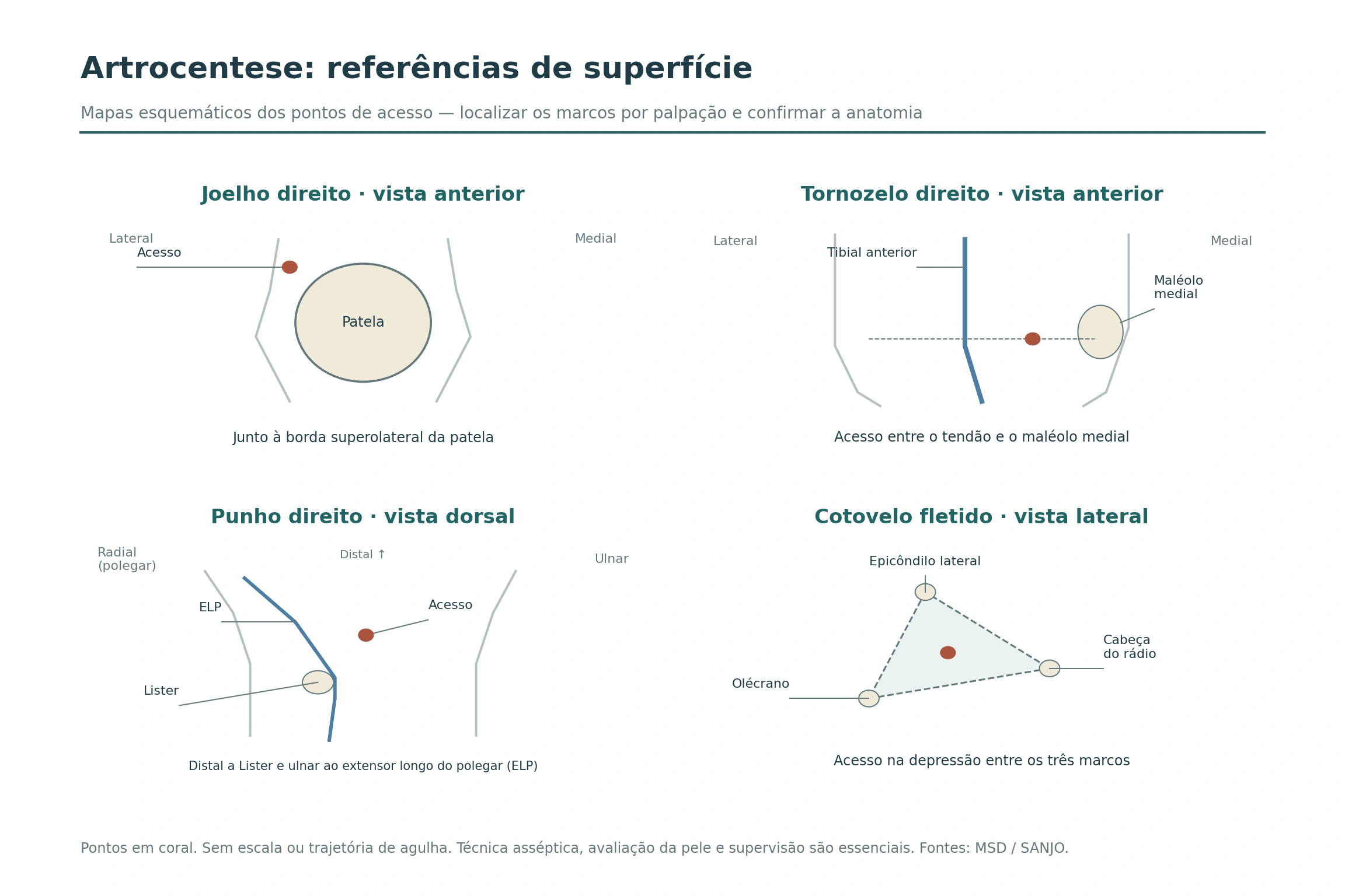 Quatro mapas de referências para artrocentese: acesso superolateral à patela; tornozelo entre tibial anterior e maléolo medial; punho distal a Lister e ulnar ao extensor longo do polegar; cotovelo entre epicôndilo lateral, olécrano e cabeça do rádio.