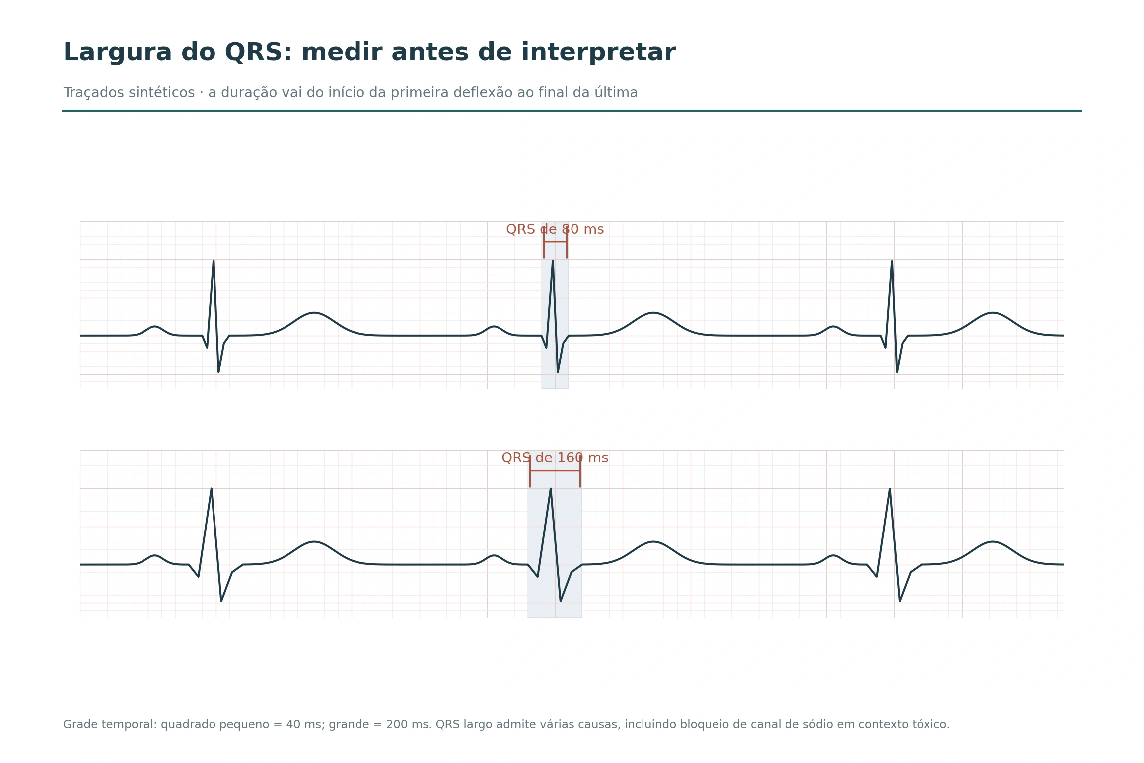 Duas faixas de ECG sintético comparam complexos QRS de 80 e 160 milissegundos em grade temporal, com a largura marcada.