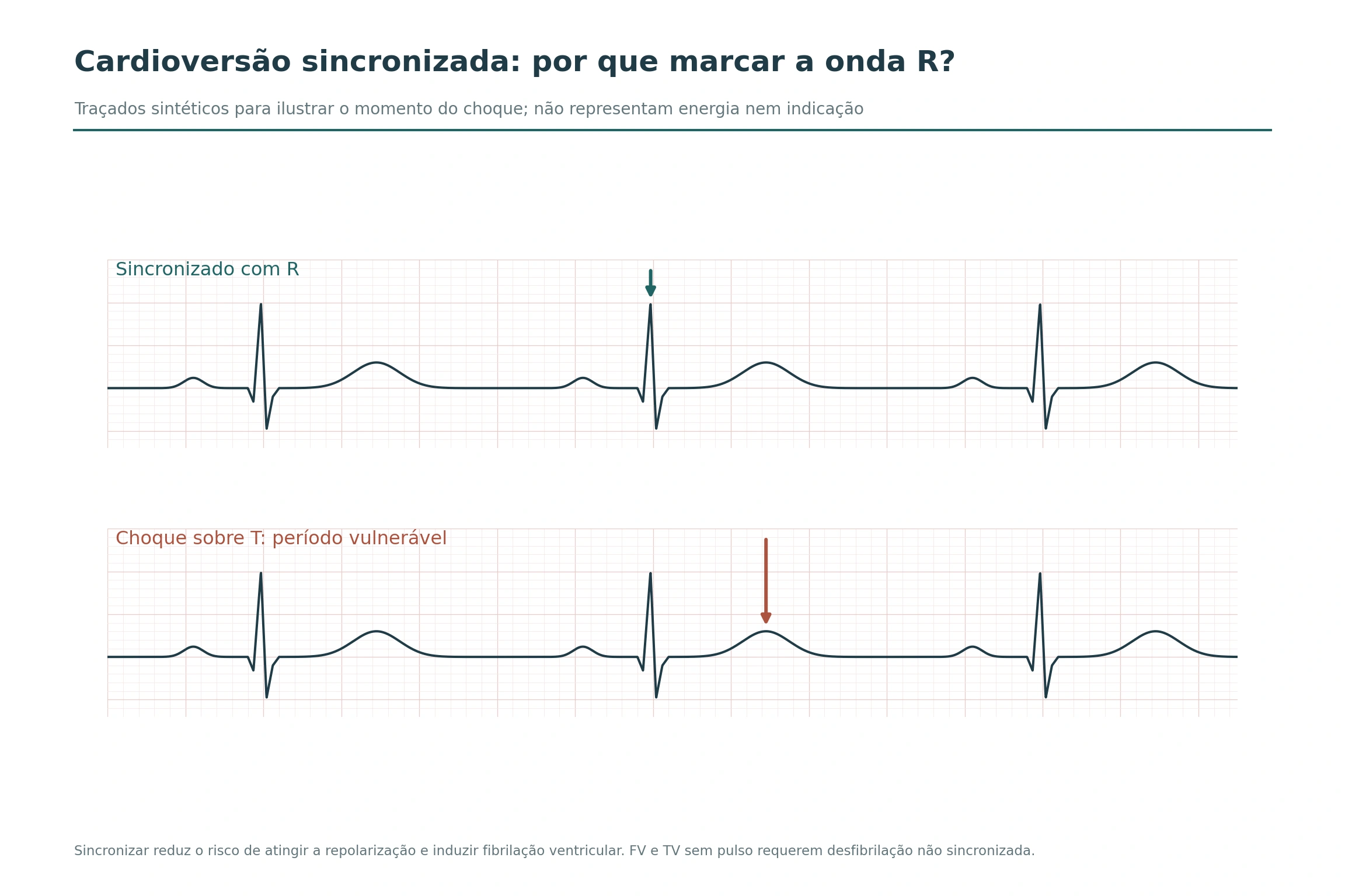 Dois ECGs sintéticos mostram um marcador de choque sobre a onda R e outro sobre a onda T.