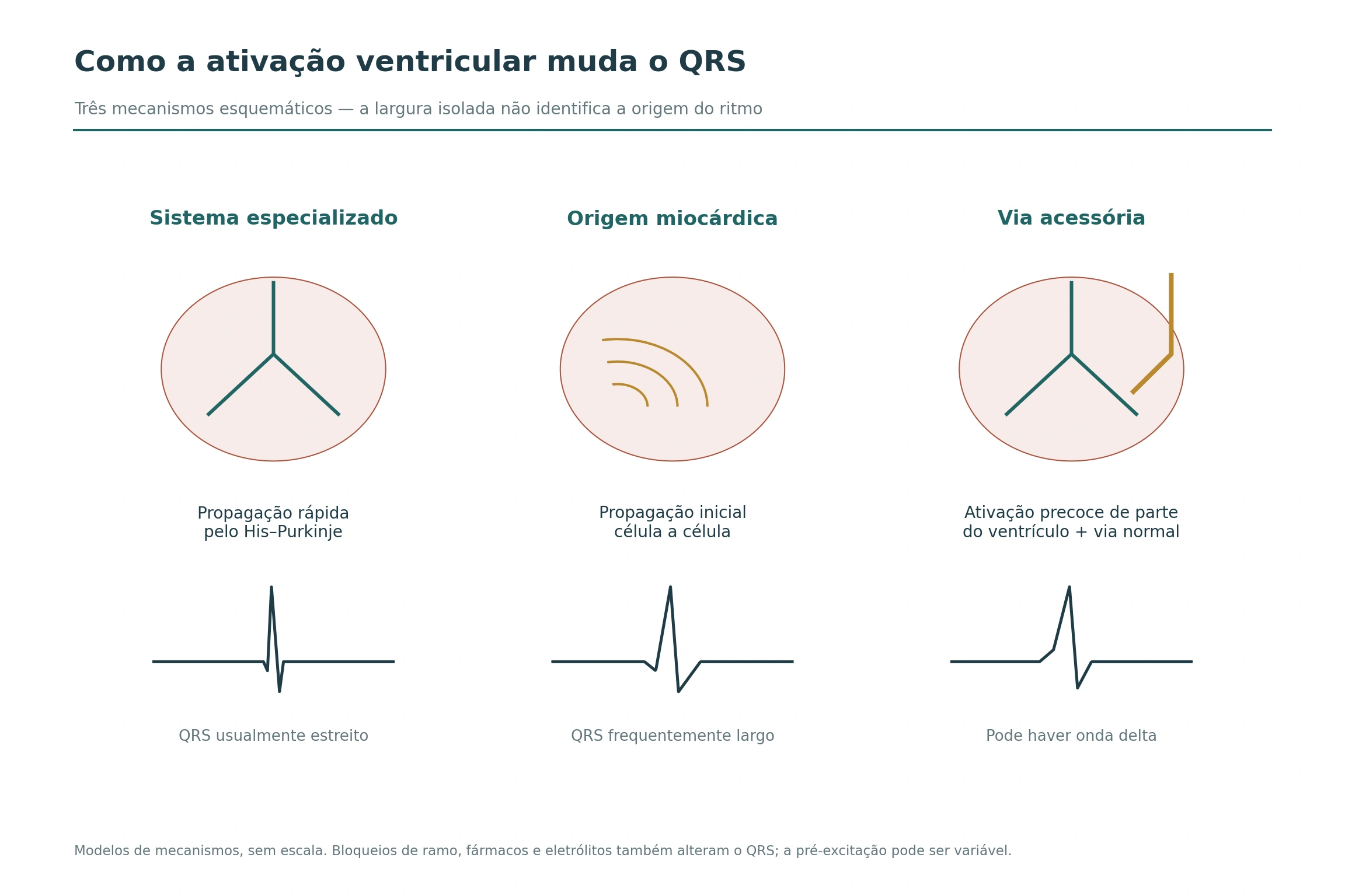 Três modelos de ativação ventricular comparam condução pelo His–Purkinje, propagação miocárdica e via acessória, acompanhados de traçados esquemáticos.