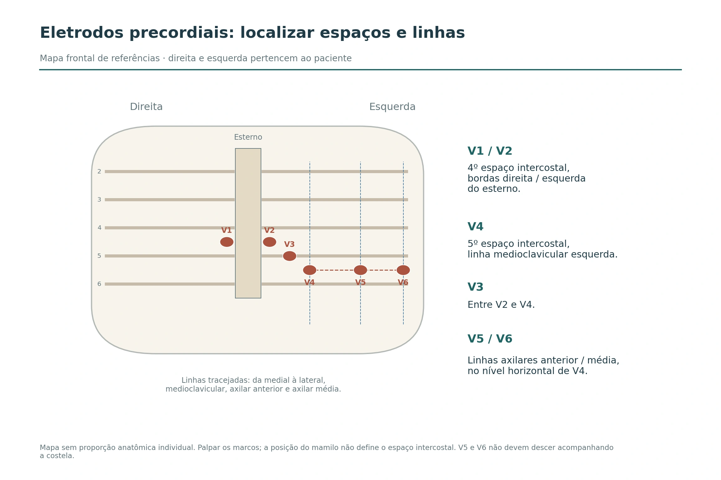 Mapa frontal do tórax marca V1 e V2 no quarto espaço intercostal, V4 no quinto espaço na linha medioclavicular, V3 entre V2 e V4, e V5/V6 no nível horizontal de V4.