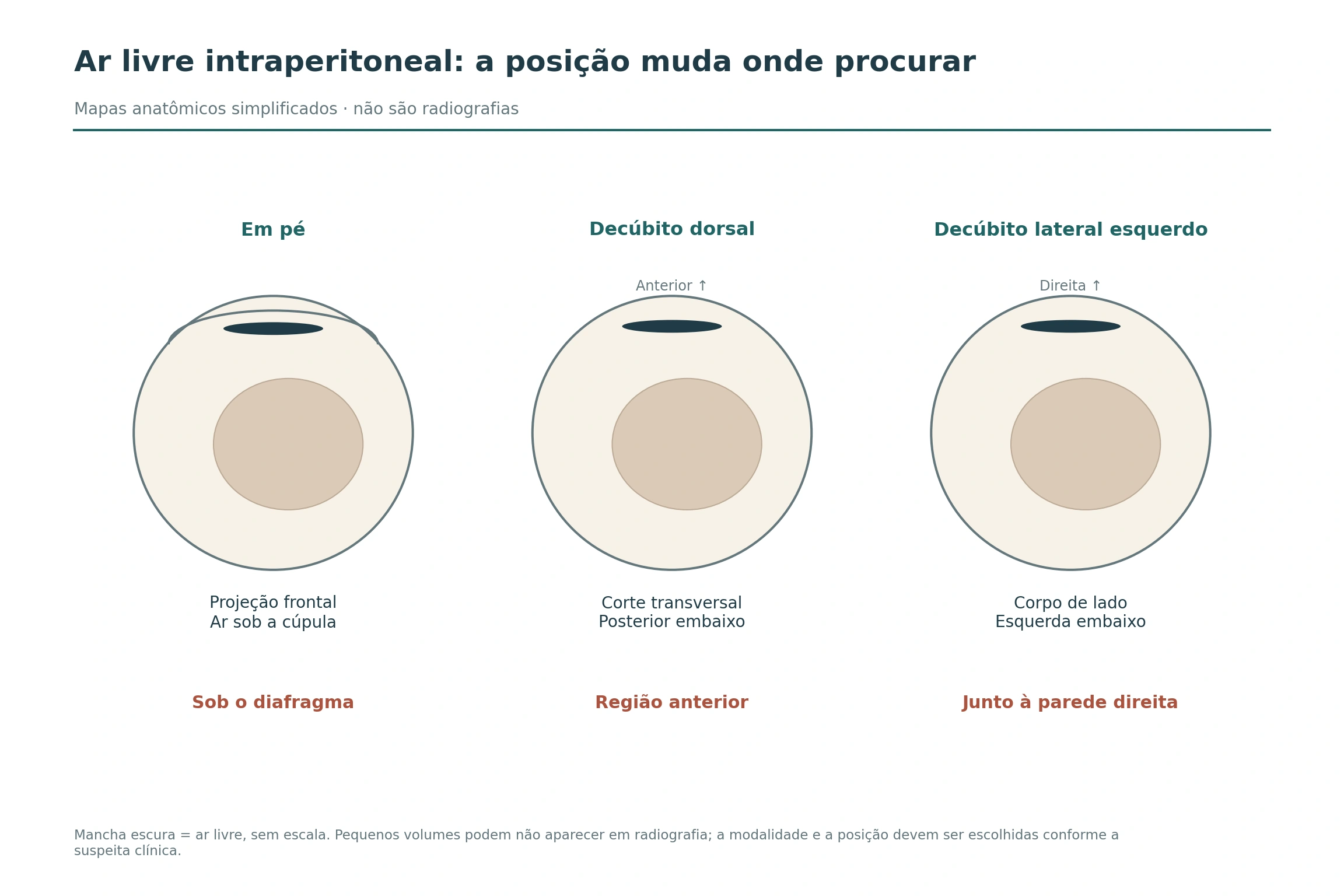 Três modelos posicionais mostram ar livre sob o diafragma em pé, anteriormente no decúbito dorsal e junto à parede direita no decúbito lateral esquerdo.