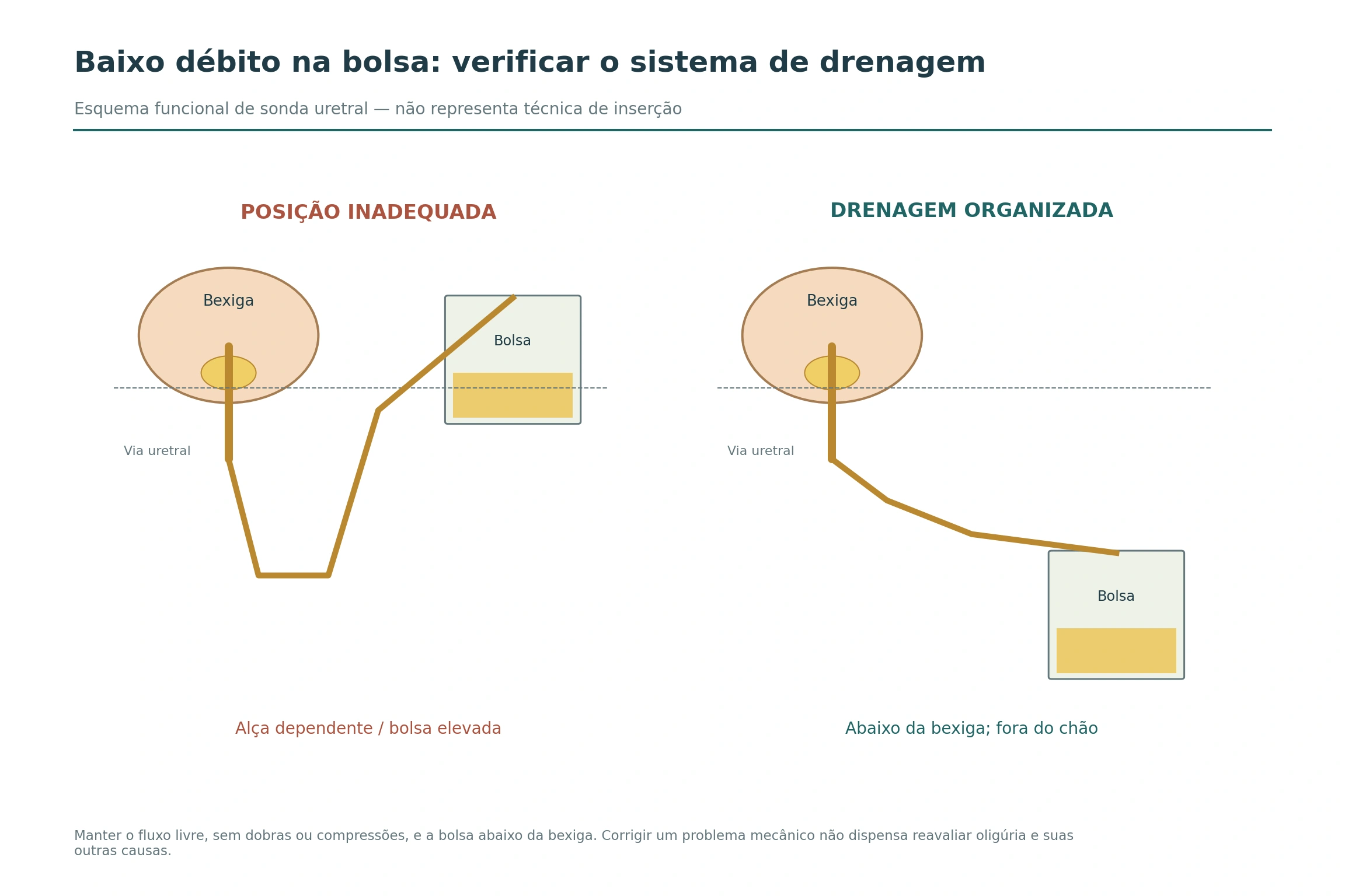 Dois sistemas de drenagem urinária por via uretral: à esquerda, alça dependente e bolsa elevada; à direita, tubo em declive e bolsa abaixo da bexiga.
