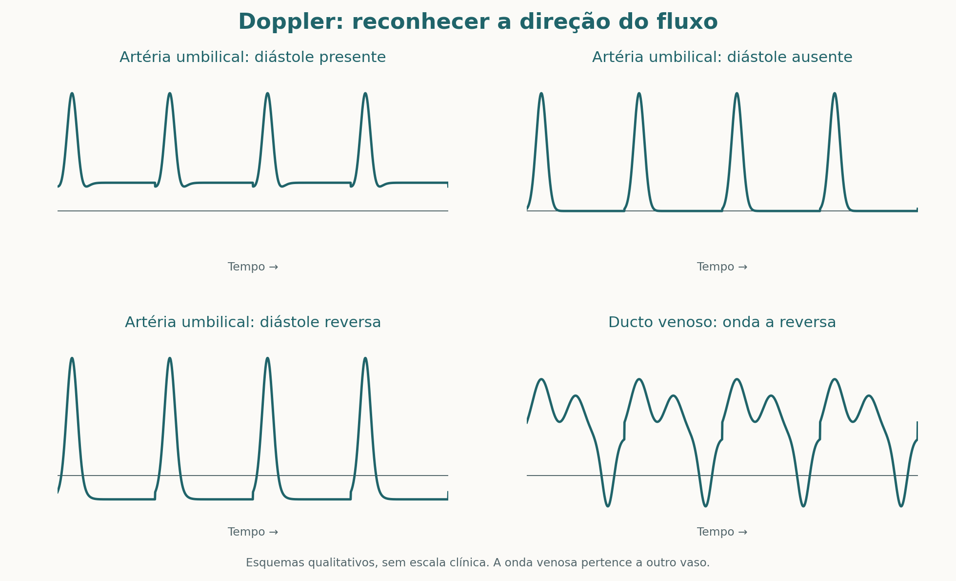 Traçados esquemáticos de Doppler: fluxo diastólico anterógrado, ausente ou reverso na artéria umbilical e onda a reversa no ducto venoso