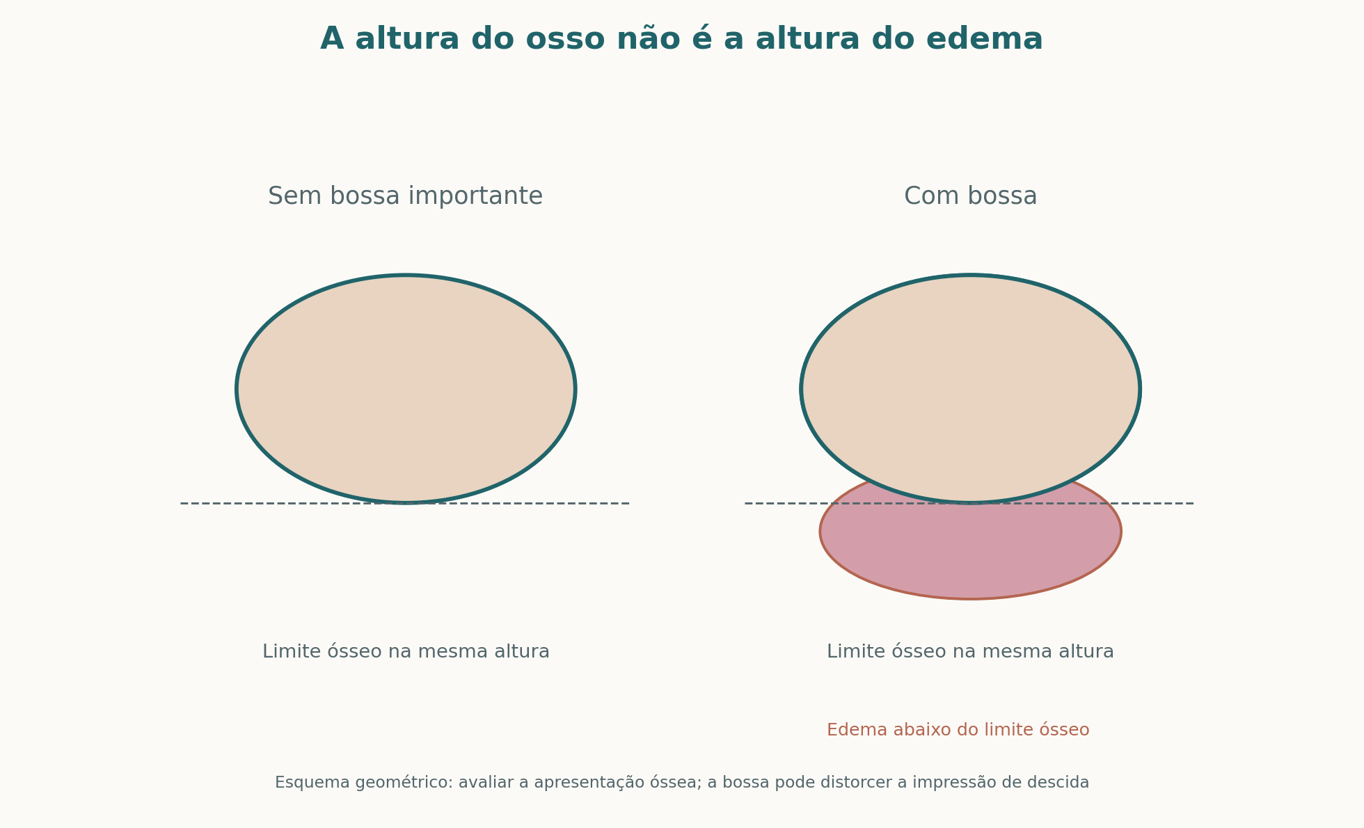 Diagrama geométrico: a bossa serossanguínea pode avançar abaixo do limite ósseo sem que a apresentação óssea tenha descido na mesma proporção.