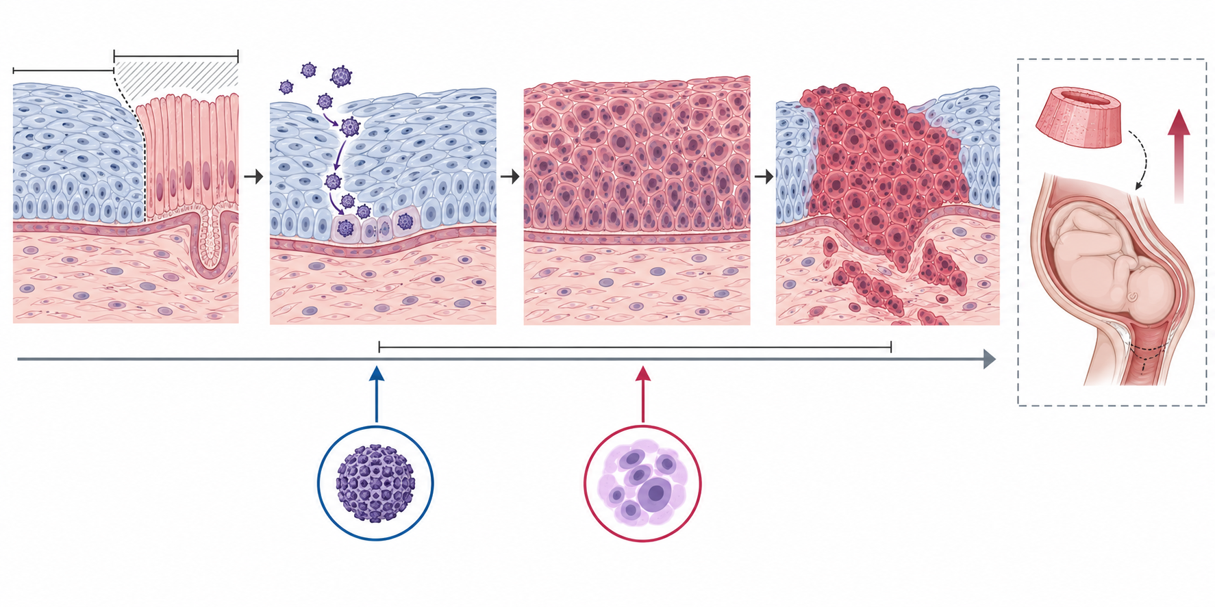 Esquema de alterações epiteliais associadas ao HPV