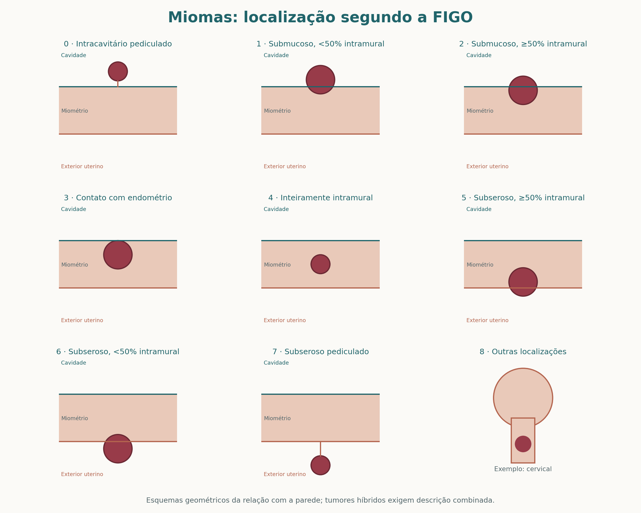 Classificação FIGO dos miomas em diagramas geométricos da relação com endométrio, miométrio e superfície externa