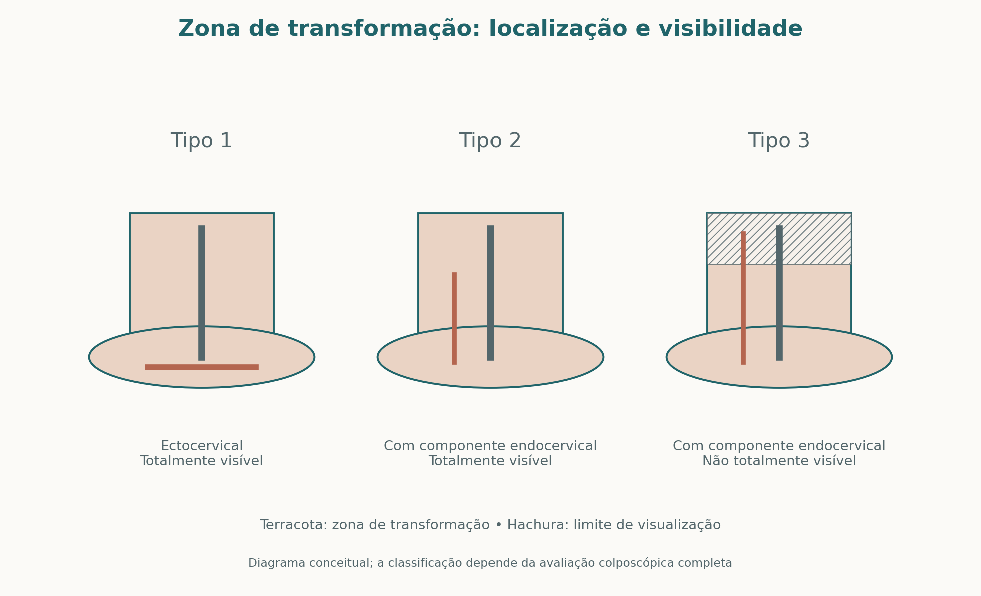 Diagrama conceitual dos tipos de zona de transformação: tipo 1 ectocervical e visível; tipo 2 com componente endocervical totalmente visível; tipo 3 não totalmente visível.