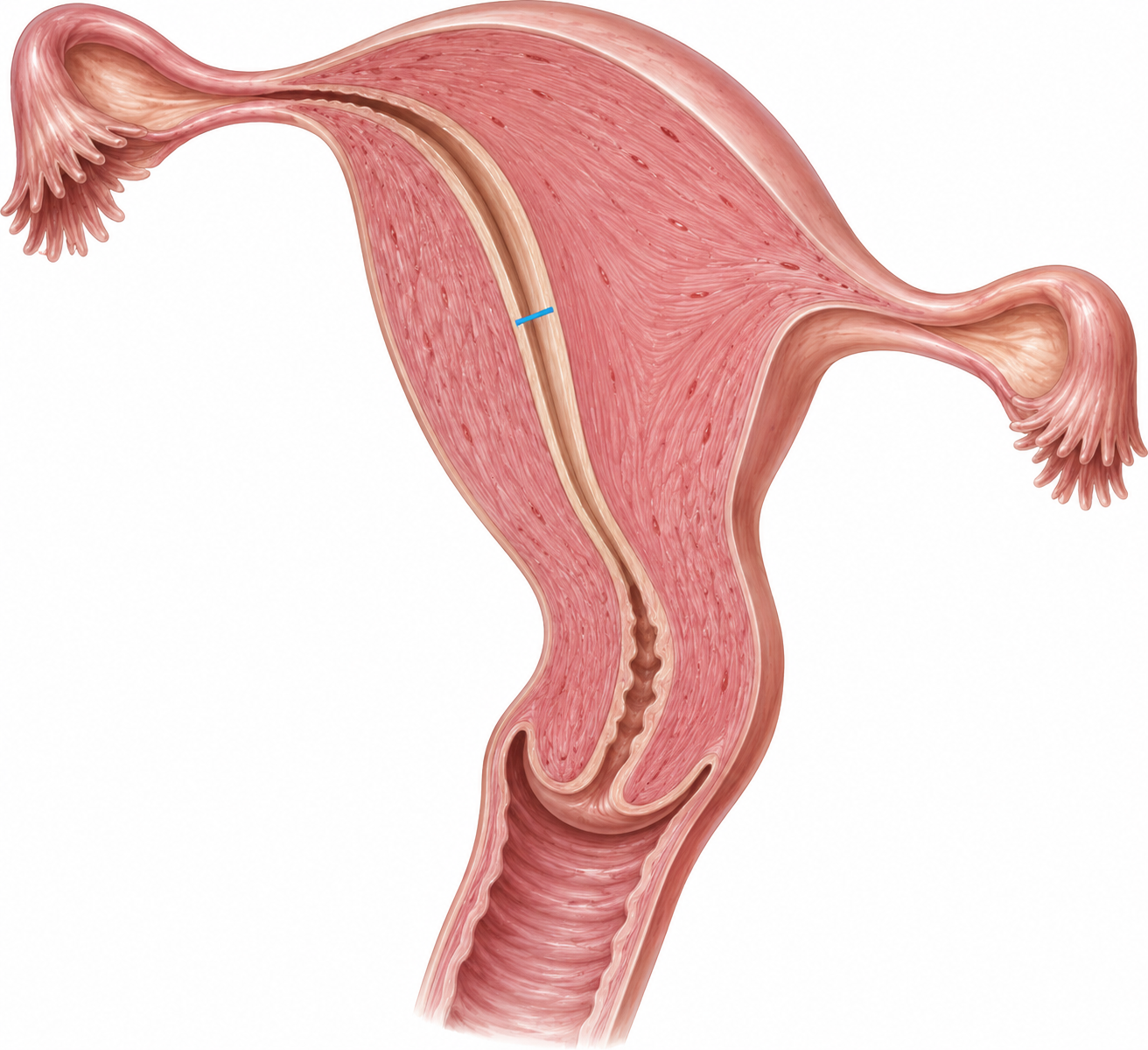 Esquema anatômico da avaliação da espessura endometrial