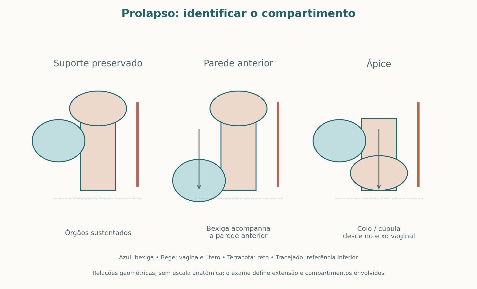 Diagramas dos compartimentos do suporte pélvico: preservado, prolapso da parede anterior e prolapso apical