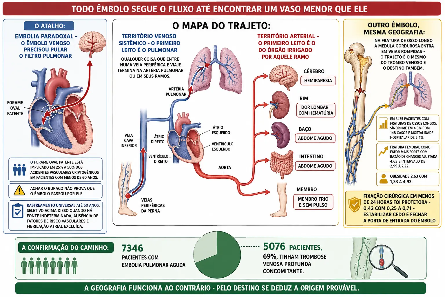 Mapa circulatório com trajetória venosa terminando no pulmão e trajetória arterial ramificando para órgãos, coração com forame oval e êmbolo cruzando para o cérebro, fêmur fraturado enviando gordura ao pulmão, e bloco com 69 por cento de trombose concomitante.