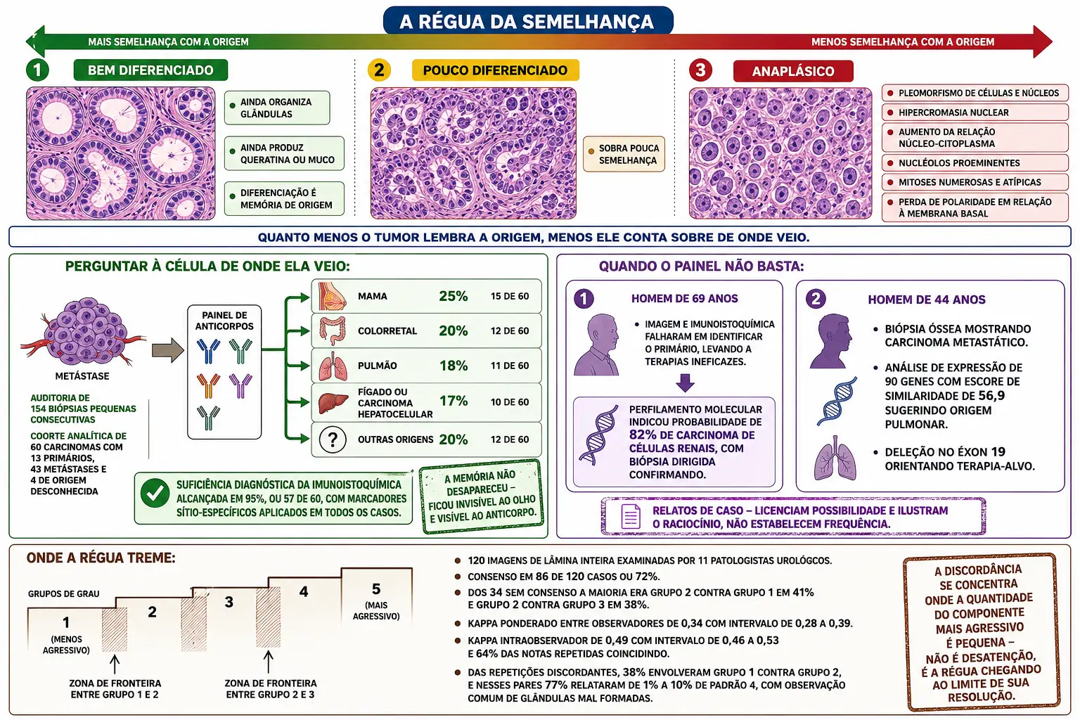 Faixa graduada de bem diferenciado a anaplásico com cortes histológicos, metástase interrogada por painel de anticorpos com percentuais de origem, dois cartões de casos com perfilamento molecular, e escada de grupos de grau com zonas de fronteira sombreadas e estatísticas de concordância.