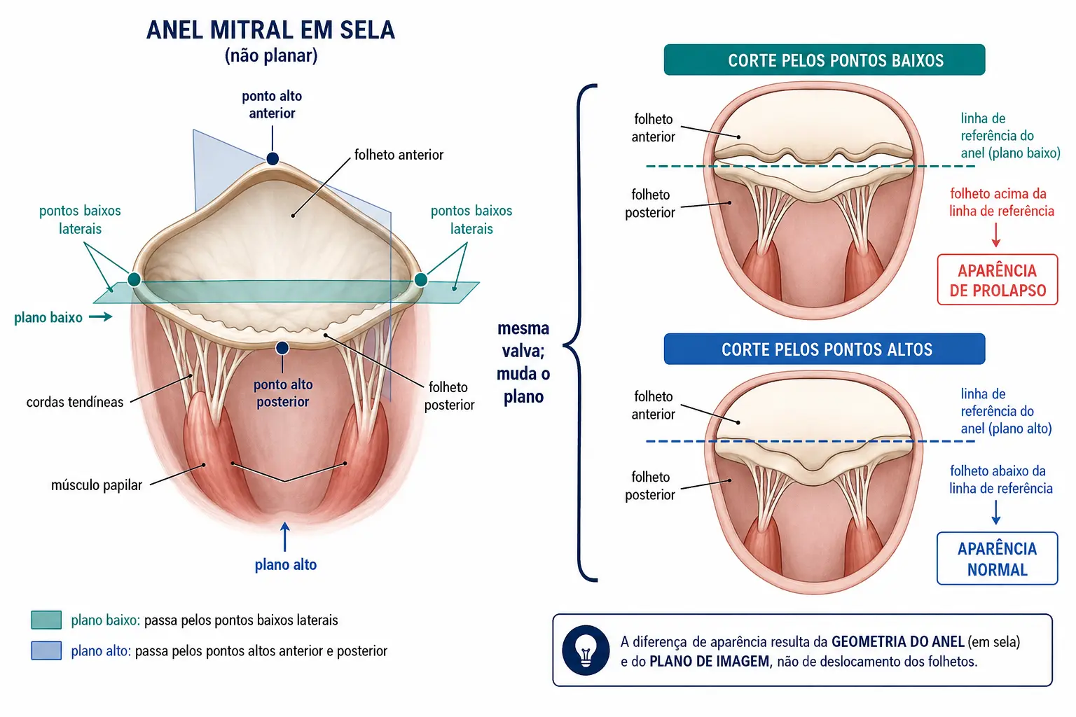 Painel duplo com o anel mitral em sela e dois planos de corte perpendiculares, mostrando a mesma valva normal parecendo prolapsada no corte pelos pontos baixos e normal no corte pelos pontos altos.