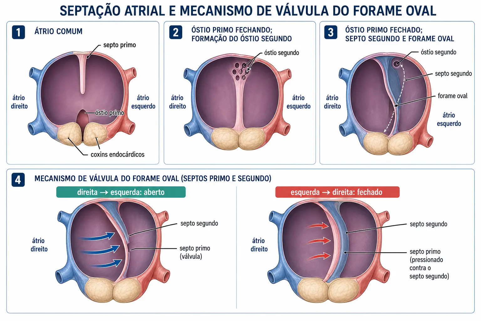 Quatro quadros da septação atrial: septo primo com óstio primo, aparecimento do óstio segundo, septo segundo com forame oval desalinhado, e o mecanismo de válvula de sentido único entre as duas lâminas.