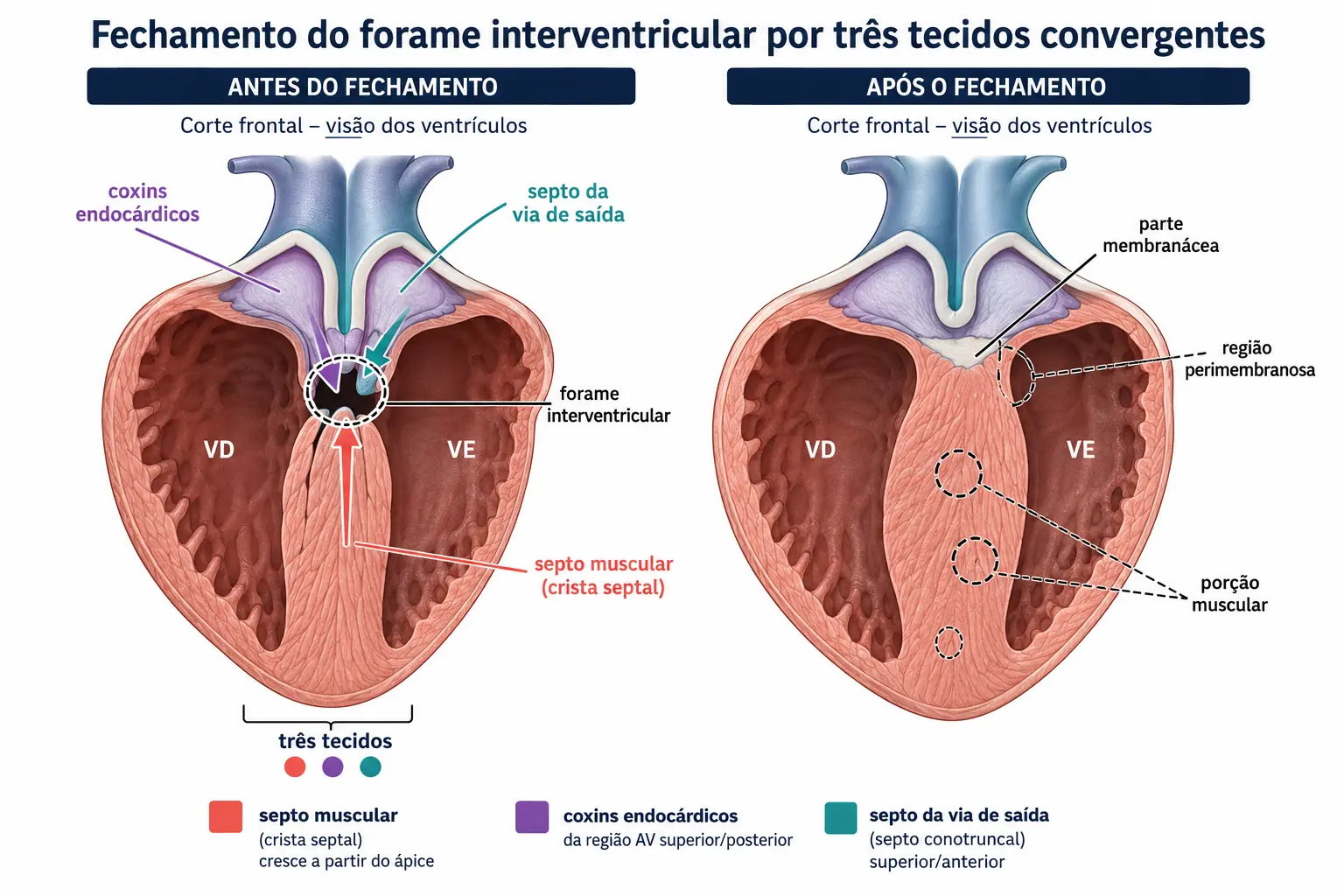 Painel duplo mostrando três tecidos de origens diferentes convergindo para fechar o forame interventricular e o septo final com a pequena parte membranácea no ponto de encontro.