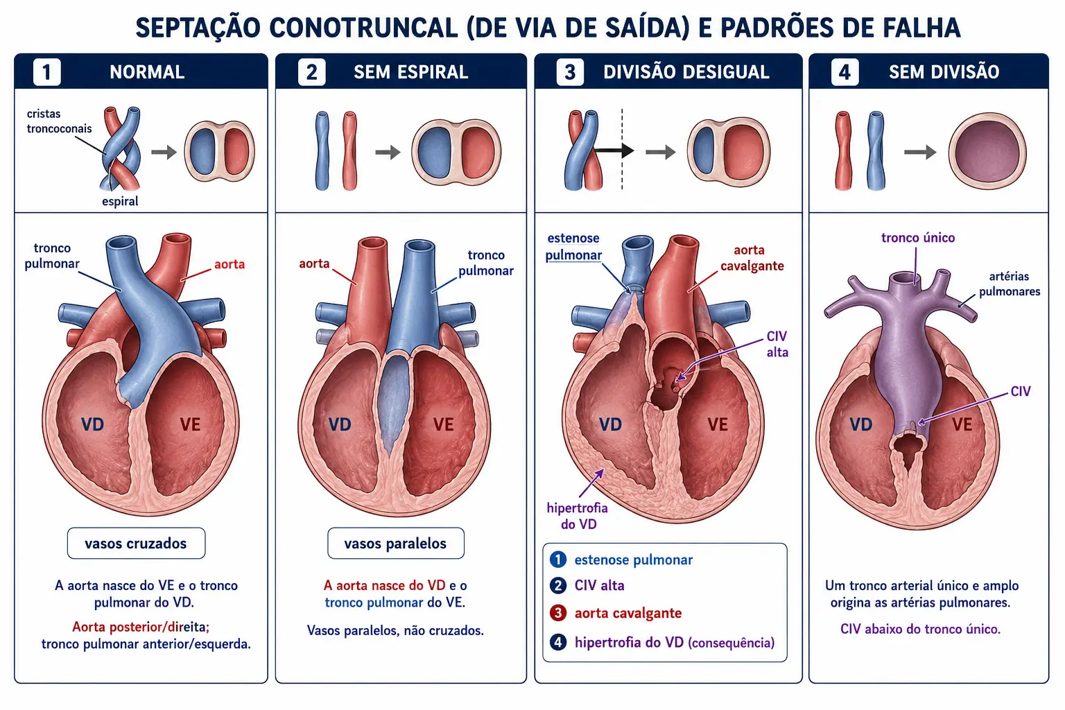 Quatro quadros comparando a divisão em espiral normal da via de saída com as três variações de falha: sem espiral, divisão desigual com deslocamento anterior do septo, e ausência de divisão com vaso único.
