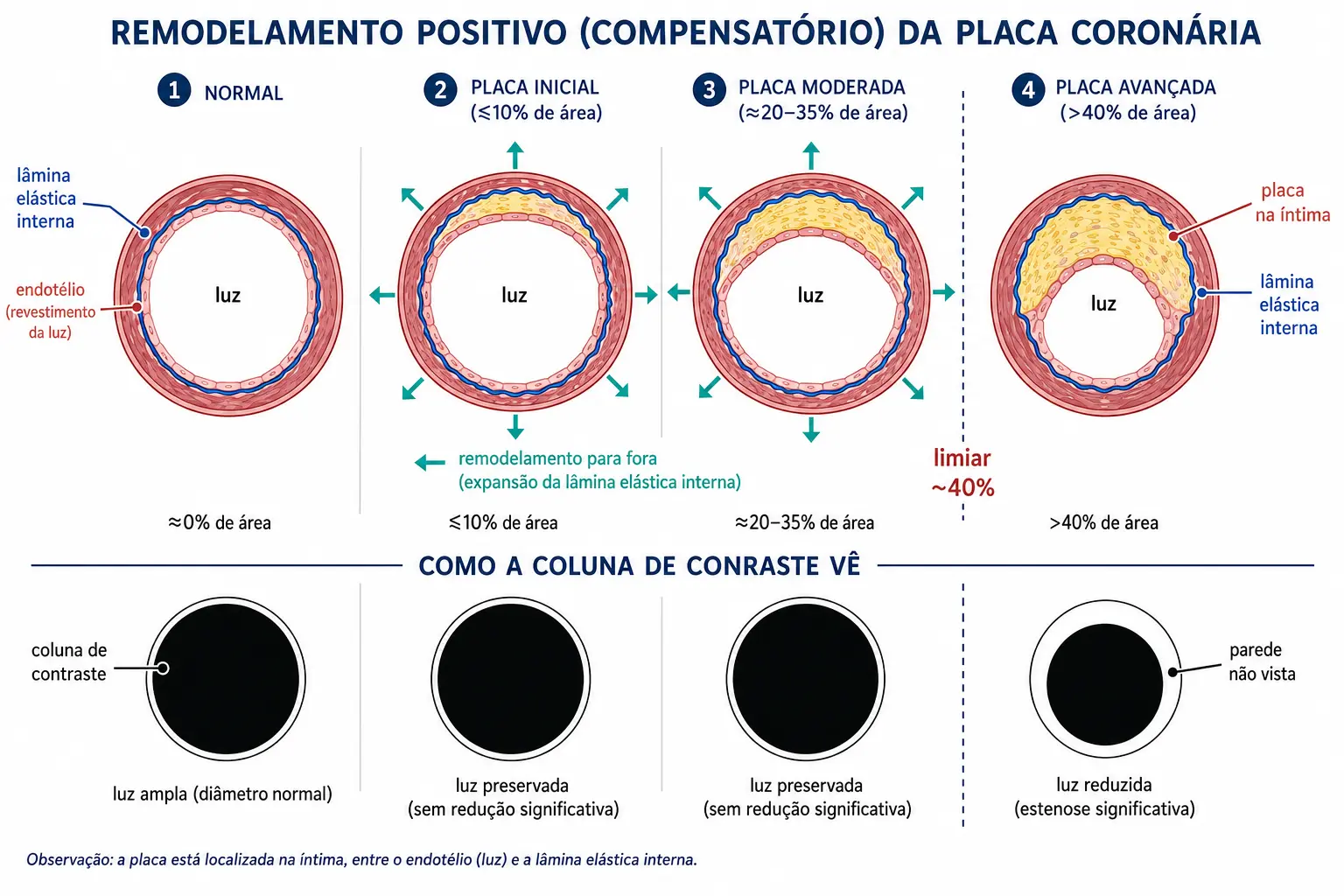 Quatro cortes de artéria coronária mostrando a placa crescendo na íntima enquanto a lâmina elástica interna se expande e a luz se mantém até 40%, e embaixo a mesma sequência vista apenas como coluna de contraste, quase idêntica nos três primeiros estágios.