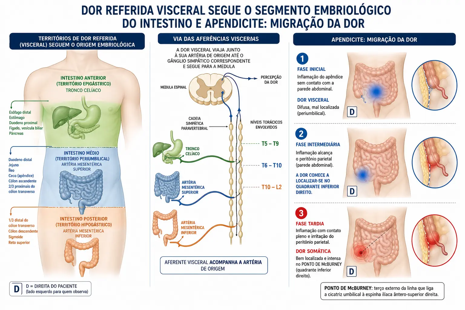 Tronco humano com três faixas de dor referida por segmento embrionário, esquema da aferente visceral acompanhando a artéria até a medula, e três quadros mostrando a migração da dor da apendicite do periumbilical para o ponto de McBurney.