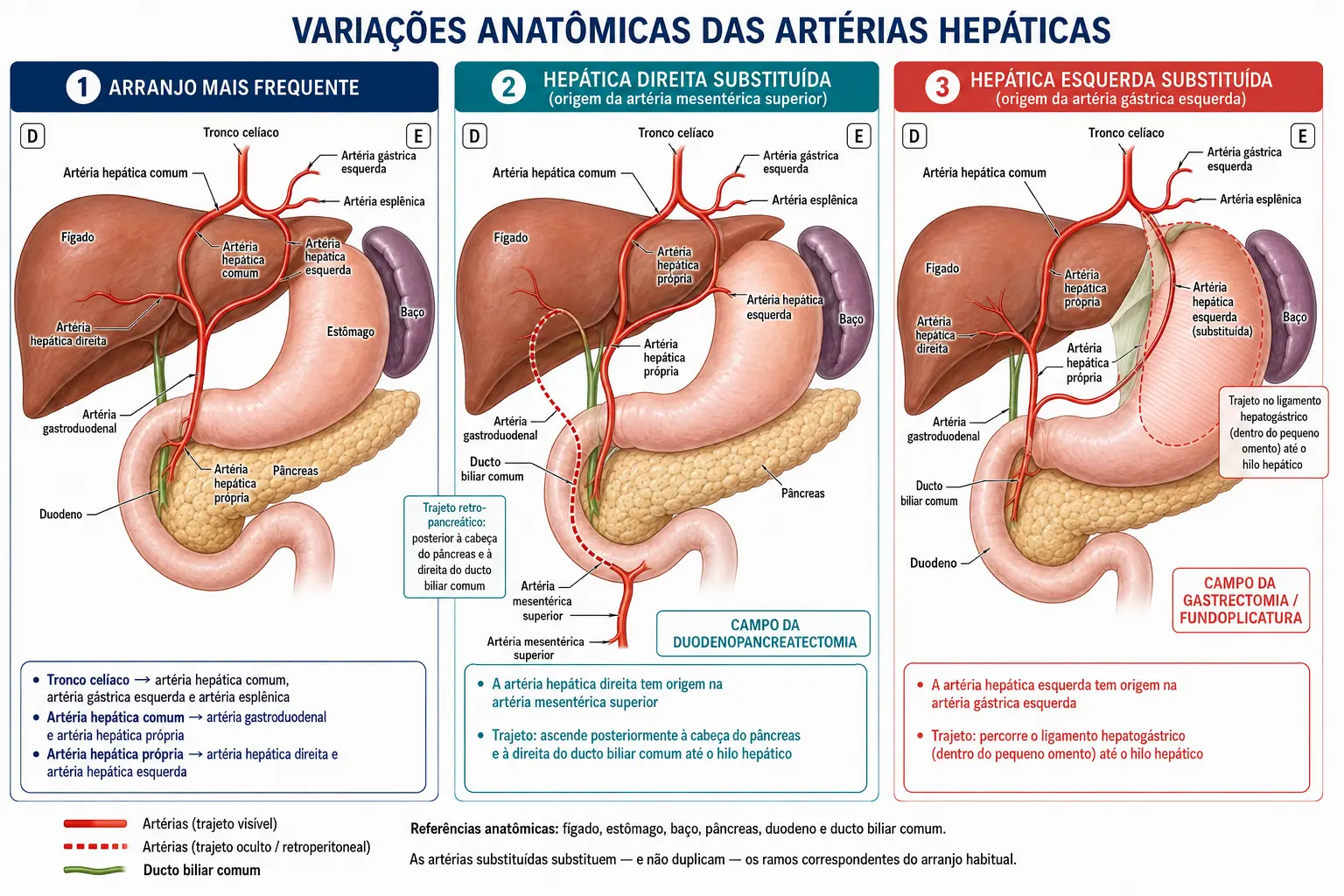 Três painéis mostrando o tronco celíaco no arranjo mais frequente, a hepática direita substituída vinda da mesentérica superior por trás da cabeça do pâncreas, e a hepática esquerda substituída vinda da gástrica esquerda dentro do ligamento hepatogástrico.