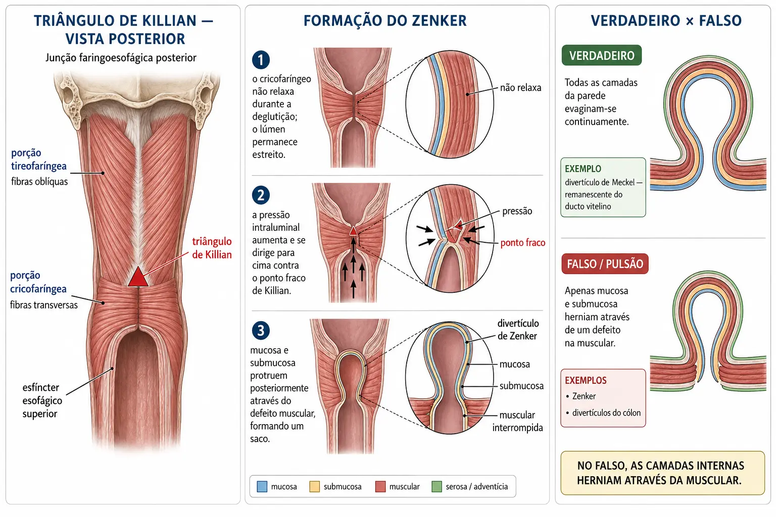 Vista posterior da faringe com as fibras oblíquas e transversas do constritor inferior delimitando o triângulo de Killian, sequência da formação do divertículo de Zenker por falha de relaxamento e pressão, e comparação entre divertículo verdadeiro com quatro camadas e falso com apenas mucosa e submucosa.