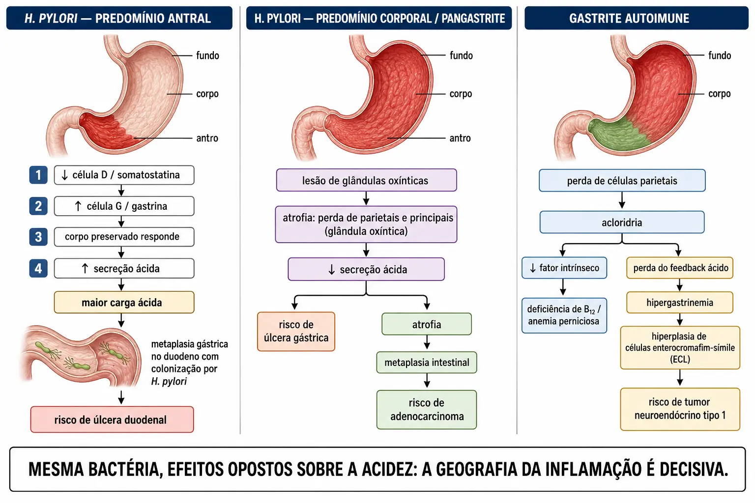 Painel duplo com gastrite antral levando a hipersecreção e úlcera duodenal por queda da somatostatina e aumento da gastrina, e gastrite de corpo levando a atrofia, hipossecreção, úlcera gástrica e carcinoma, com um quadro lateral da gastrite autoimune poupando o antro.