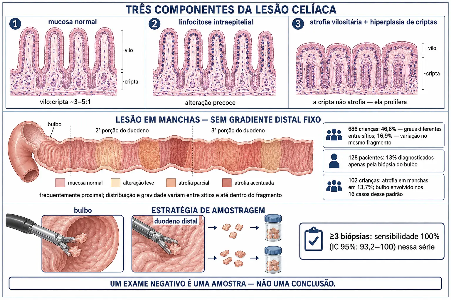 Três cortes mostrando mucosa normal, linfocitose intraepitelial e atrofia vilositária com hiperplasia de criptas, o duodeno desdobrado com gravidade variável entre sítios e os blocos de dados das três séries, e a estratégia de coleta com múltiplos fragmentos incluindo o bulbo.