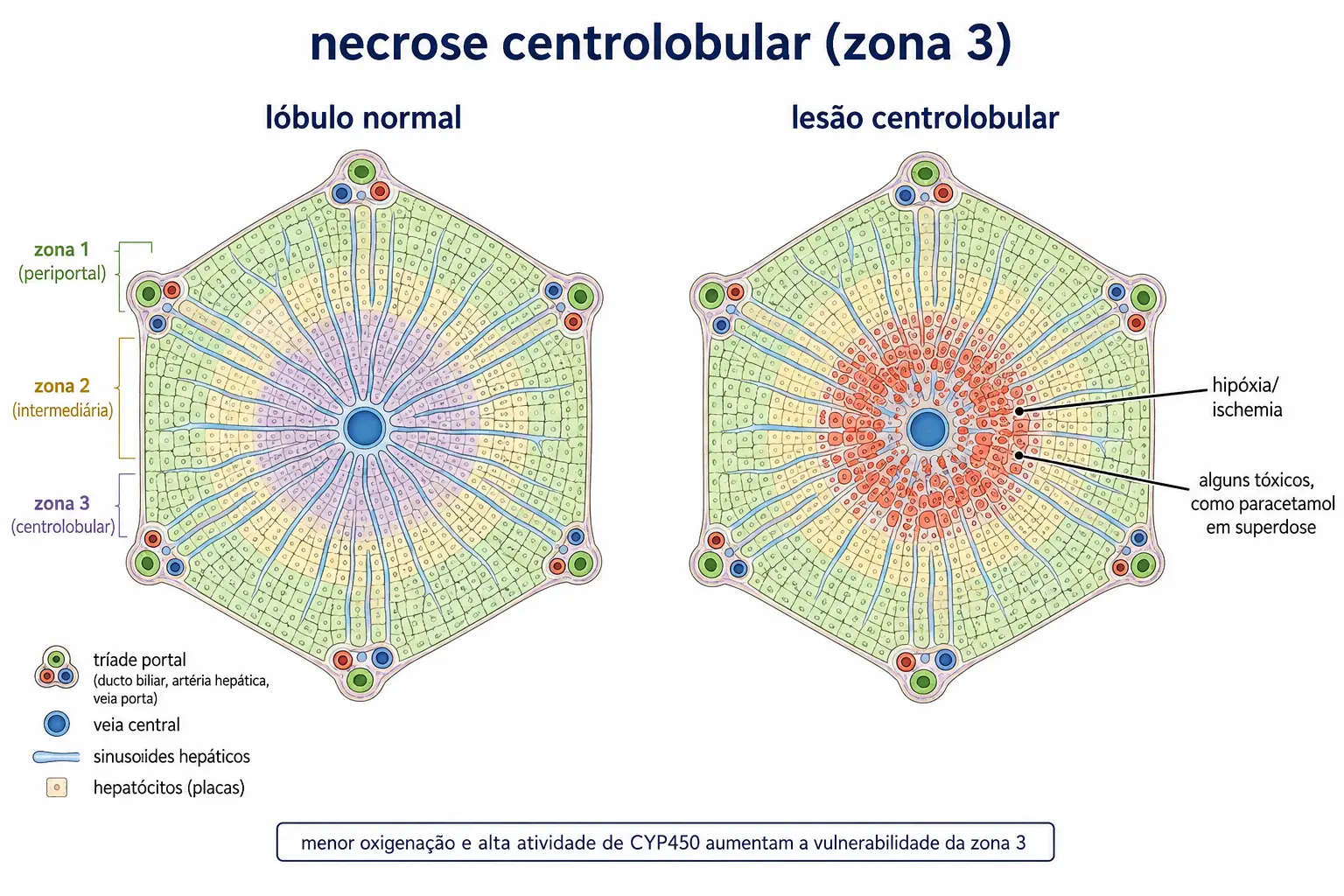 Painel duplo comparando lóbulo hepático normal e lóbulo com necrose ao redor da veia centrolobular, com a zona periportal preservada.