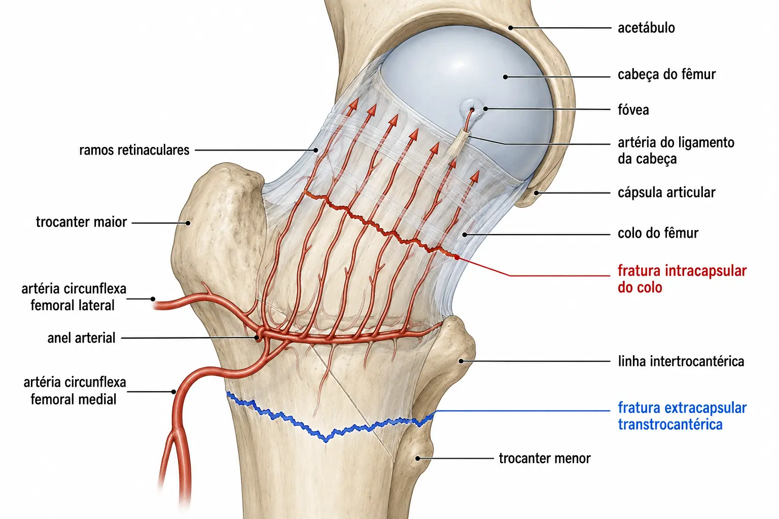 Fêmur proximal com a cápsula envolvendo o colo, o anel arterial das circunflexas femorais e os ramos retinaculares subindo pelo colo, com uma linha de fratura intracapsular cortando esses ramos e outra extracapsular abaixo da cápsula.