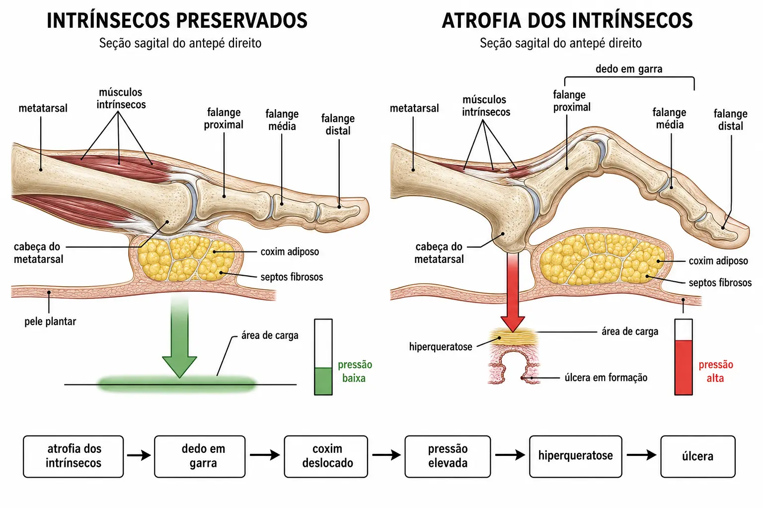 Dois cortes sagitais do antepé: com intrínsecos preservados o coxim adiposo fica sob a cabeça do metatarsal e a carga se distribui; com atrofia, o dedo em garra empurra a cabeça para baixo, o coxim migra para frente e a pressão se concentra, formando calo e úlcera.