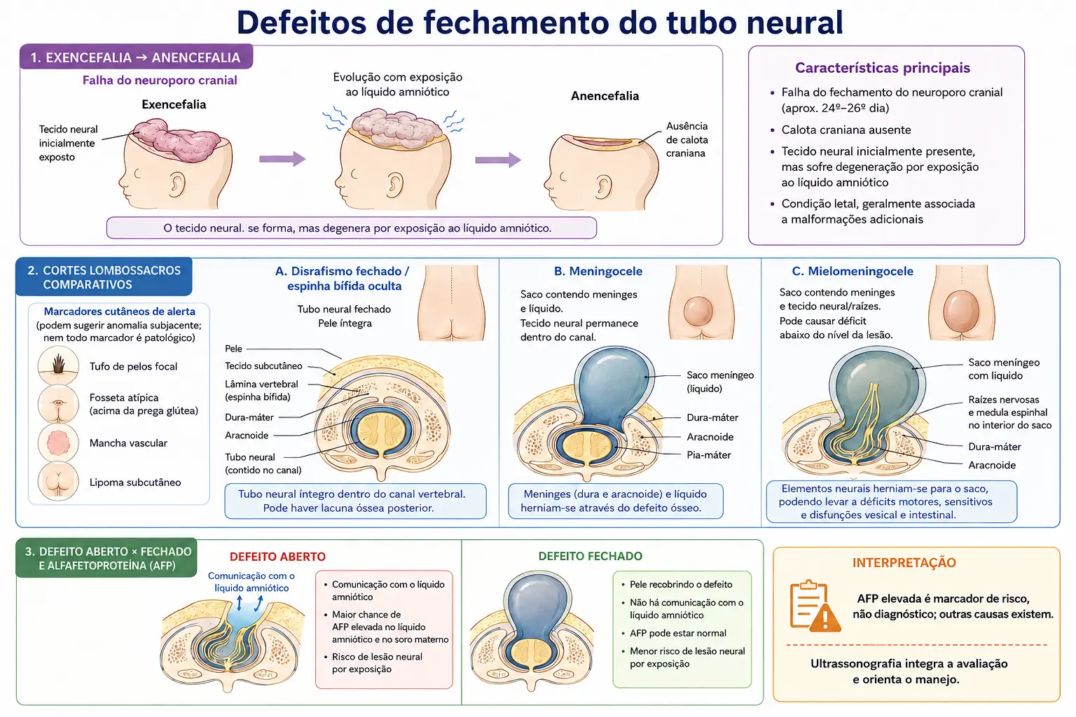 Embrião com falha do neuroporo anterior e anencefalia, três cortes lombossacros comparando espinha bífida oculta com marcadores cutâneos, meningocele e mielomeningocele, e blocos mostrando o vazamento de alfafetoproteína apenas no defeito aberto.