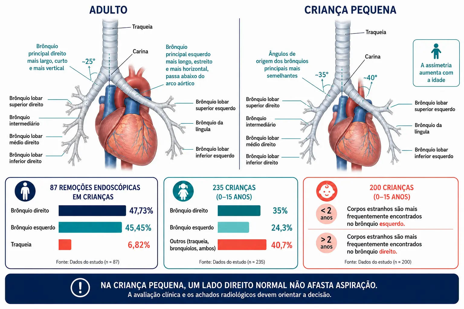 Assimetria dos brônquios principais no adulto com ângulos diferentes e na criança pequena com ângulos parecidos, acompanhada de três blocos com os dados medidos de lateralidade do corpo estranho em séries pediátricas.
