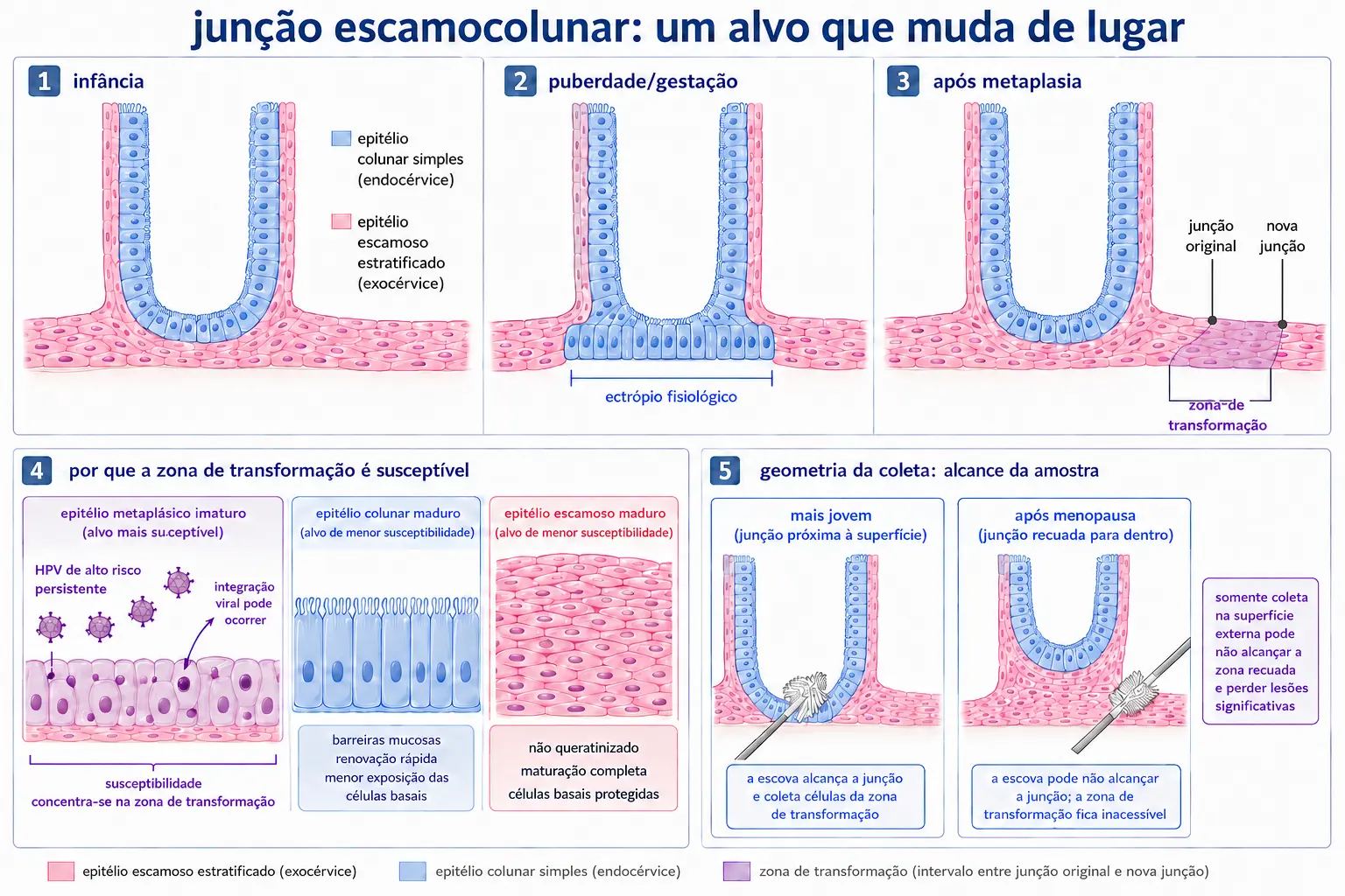 Três cortes do colo mostrando a junção escamocolunar dentro do canal na infância, evertida com ectrópio na puberdade, e a zona de transformação delimitada entre a junção original e a nova após a metaplasia, com painéis sobre a suscetibilidade da célula metaplásica e a mudança do local de coleta com a idade.