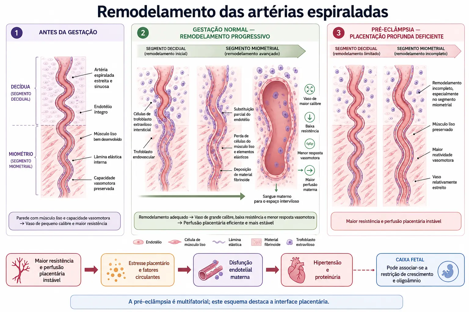 Três quadros mostrando a artéria espiralada muscular sendo invadida pelo trofoblasto e transformada em tubo largo e flácido, linha do tempo com as duas ondas de invasão, e a cadeia de consequências da falha da segunda onda até hipertensão e proteinúria.