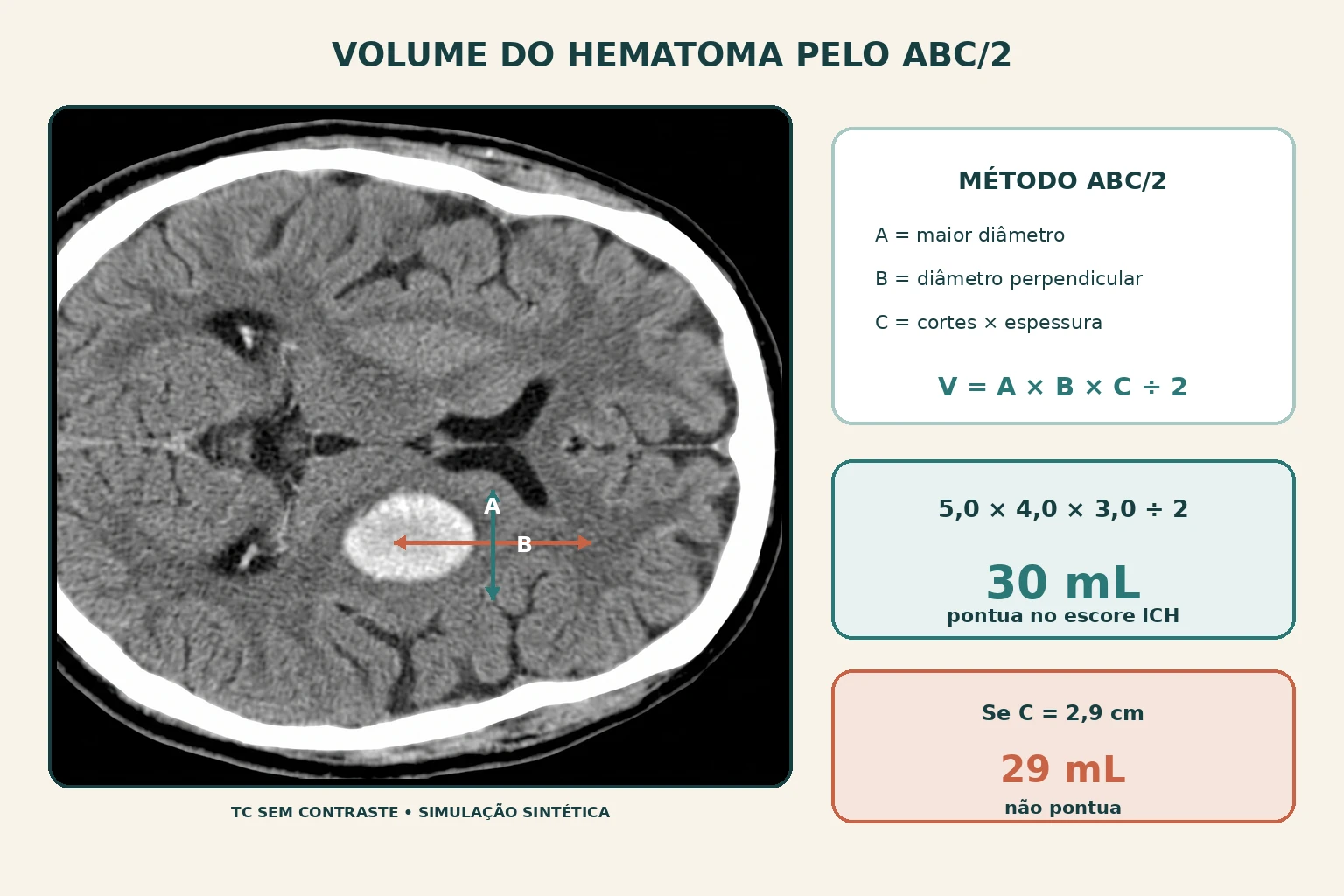 Dois esquemas do mesmo hematoma lado a lado, cada um com as três medidas do método ABC dividido por dois. À esquerda, C de 3,0 cm resulta em 30 mL e pontua no escore ICH; à direita, C de 2,9 cm resulta em 29 mL e não pontua. Uma régua na base liga os dois resultados a mortalidades de 72% e 26% em trinta dias.