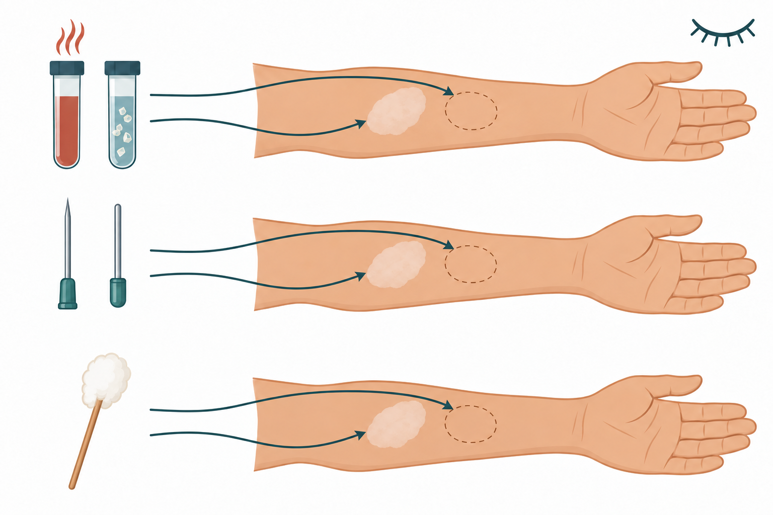 Três linhas com instrumentos térmicos, ponta e extremidade romba para estímulo doloroso, e algodão; em cada linha as setas comparam uma mancha clara à pele sadia adjacente. Símbolo de olhos fechados.