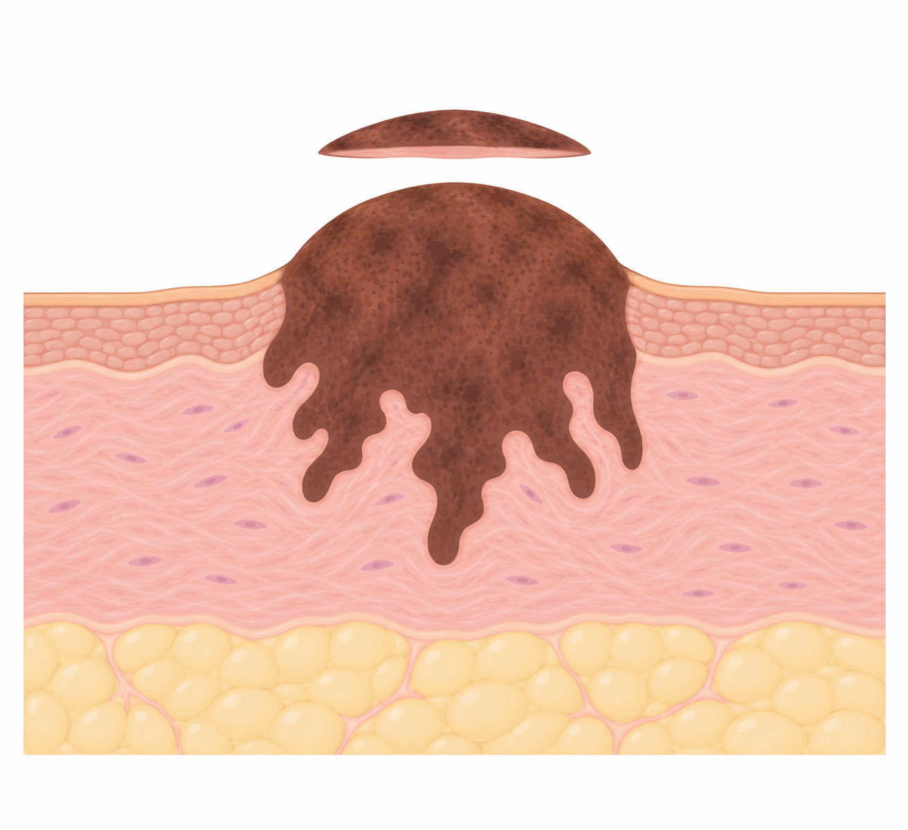 Corte vertical da pele em três faixas sobrepostas. Um tumor em forma de cúpula sai da faixa superior e afunda na faixa média com uma borda profunda irregular. Acima da pele, separada por um espaço, flutua uma lâmina fina de tecido que corresponde só ao topo da cúpula; a borda profunda continua dentro da pele.