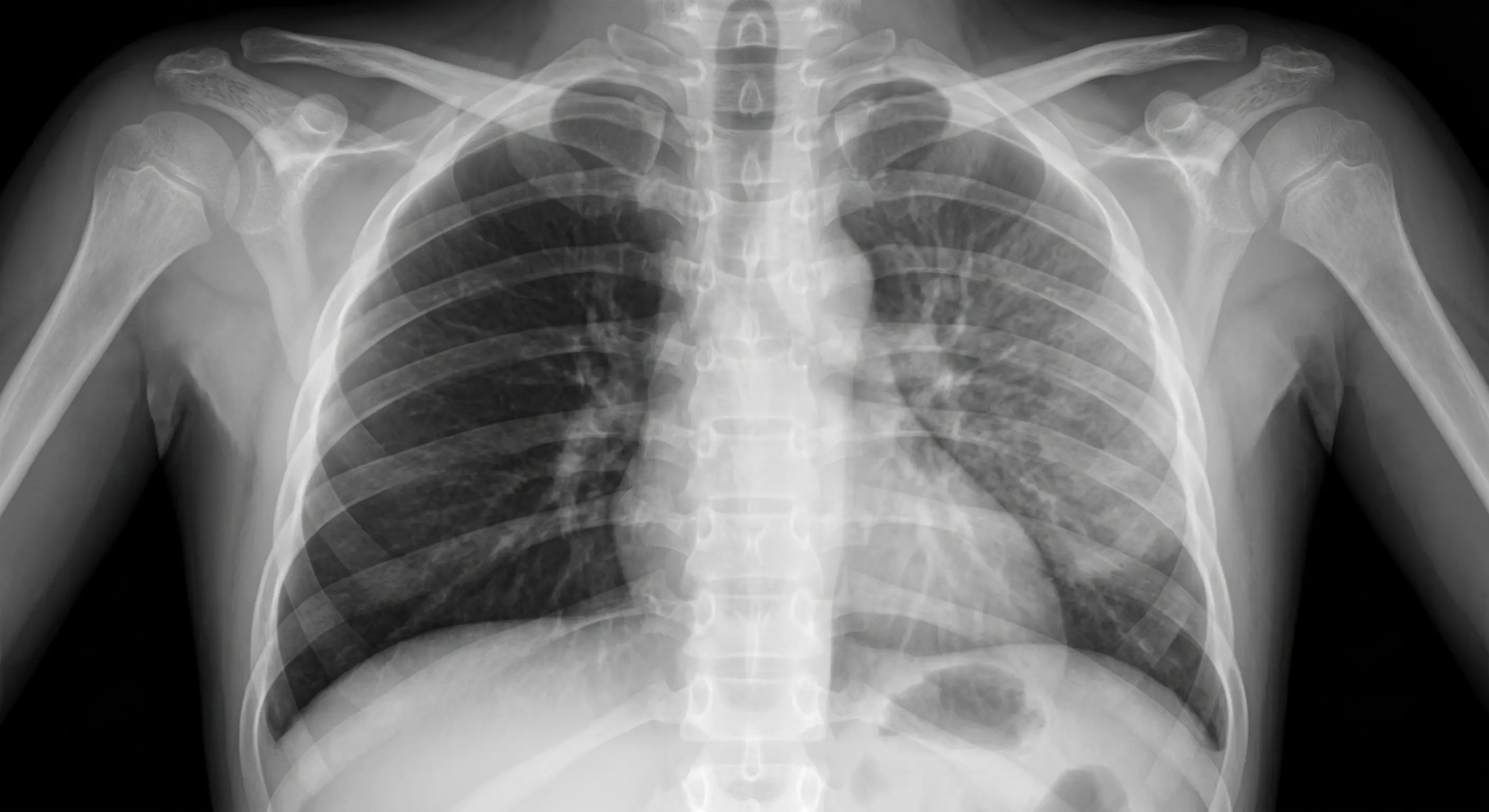 Radiografia expiratória de tórax pediátrica com aprisionamento aéreo unilateral à direita: pulmão direito hipertransparente e hiperinsuflado, hemidiafragma rebaixado e discreto desvio mediastinal para a esquerda, sem corpo estranho radiopaco.