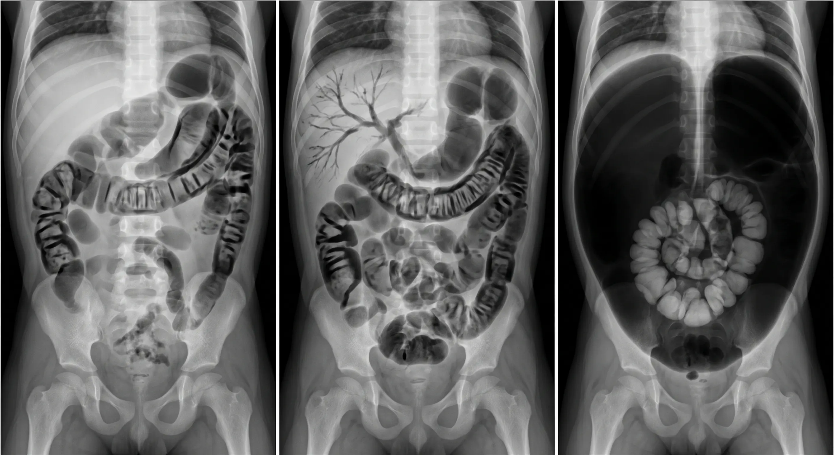 Tríptico de radiografias abdominais neonatais seriadas mostrando pneumatose intestinal, gás venoso portal e pneumoperitônio com sinal do futebol.