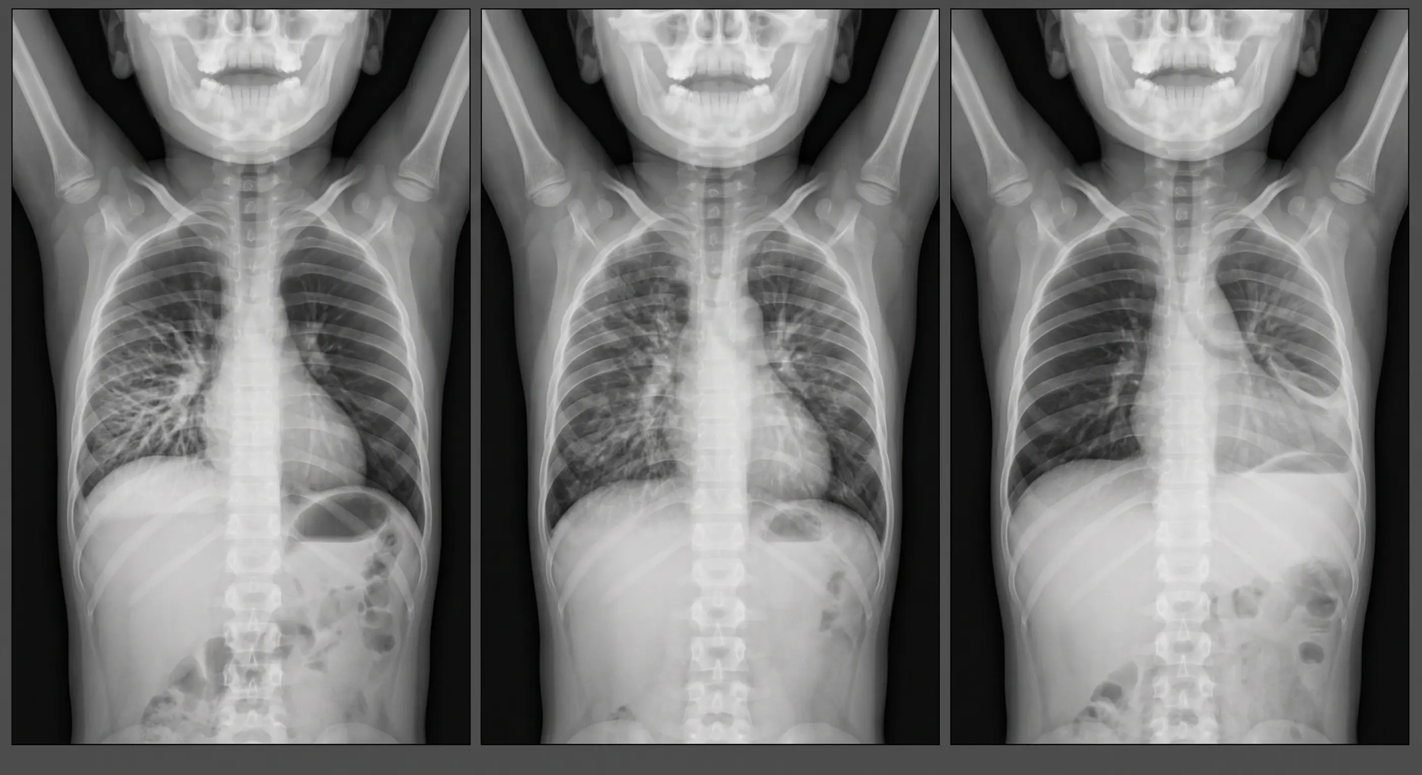 Três radiografias de tórax pediátricas mostram consolidação lobar com broncograma aéreo, padrão intersticial bilateral e derrame pleural unilateral com sinal do menisco.