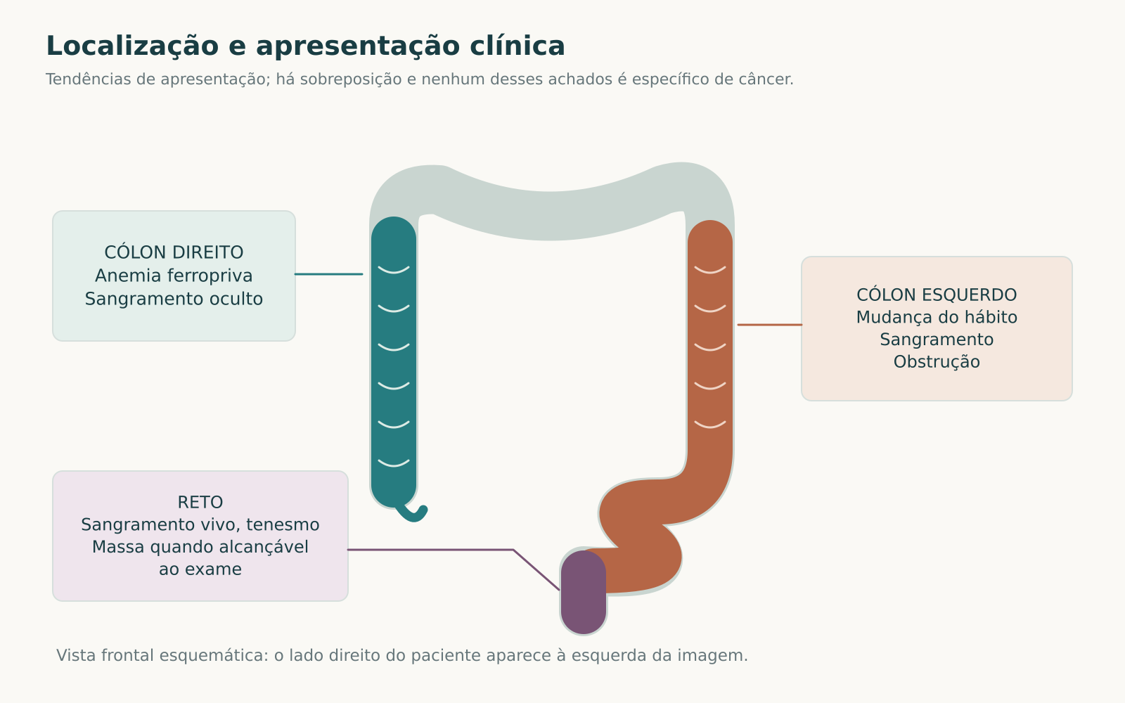 Mapa frontal do cólon com regiões direita, esquerda e retal, acompanhado de tendências de apresentação clínica.