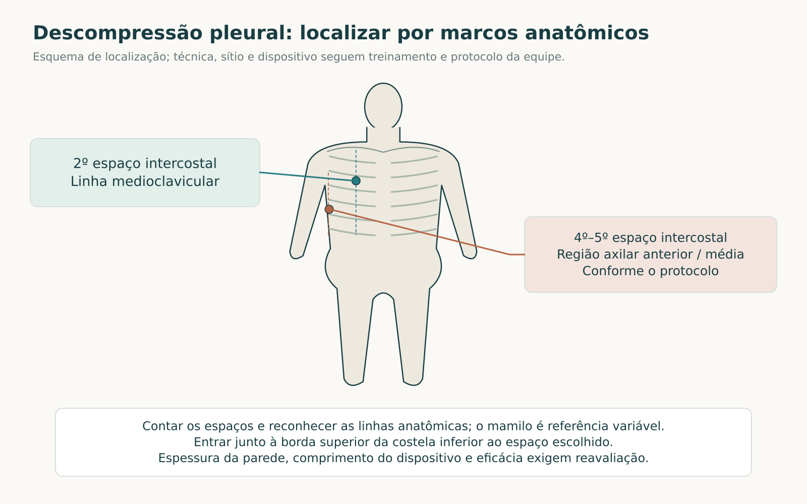 Mapa torácico frontal com o segundo espaço intercostal na linha medioclavicular e a região do quarto ao quinto espaço nas linhas axilares anterior ou média.