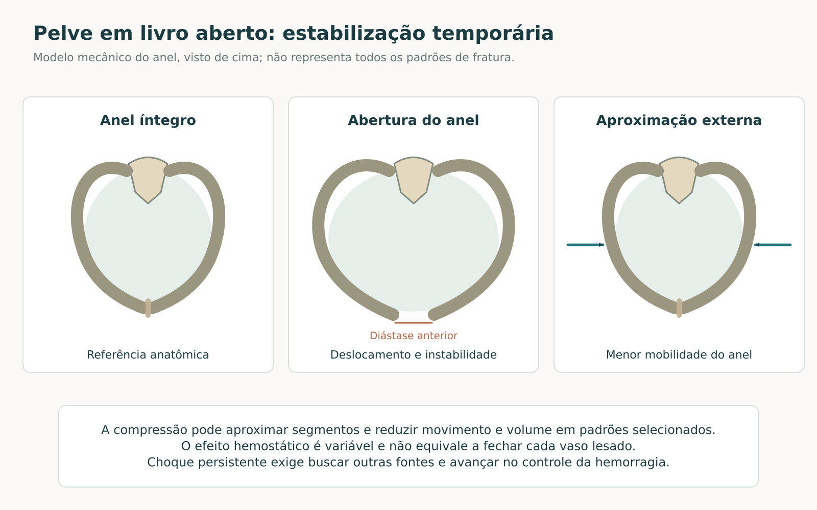 Três modelos do anel pélvico vistos de cima: íntegro, com diástase anterior e aproximado por forças de compressão externa.