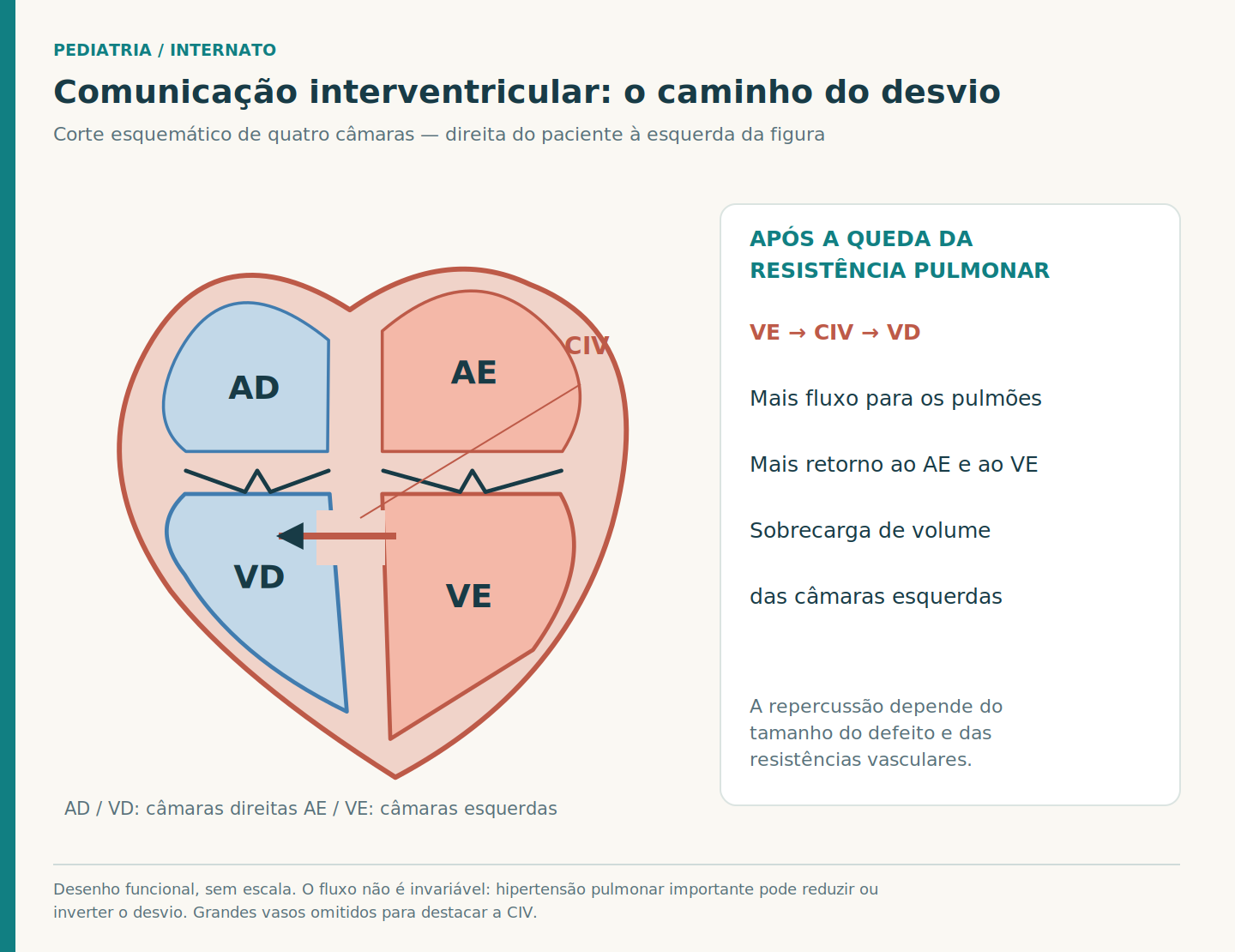 Corte funcional de quatro câmaras com comunicação na porção superior do septo ventricular, seta do ventrículo esquerdo para o direito e câmaras esquerdas representadas maiores; grandes vasos omitidos.
