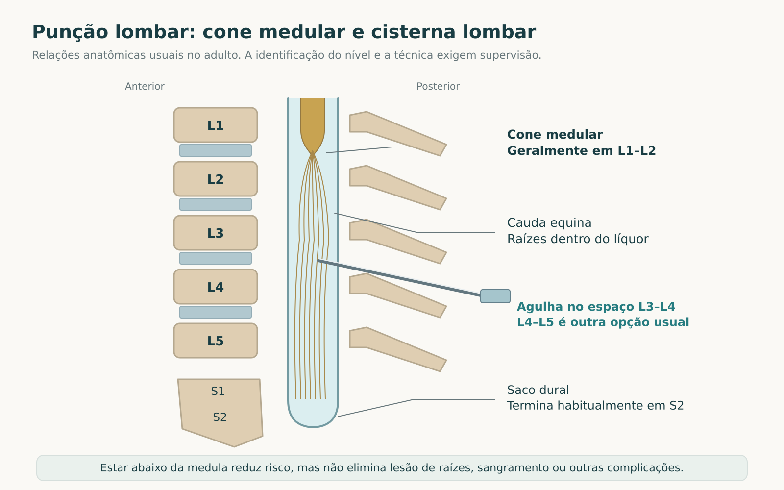 Esquema sagital com cinco vértebras lombares, cone medular usual em L1-L2, cauda equina, saco dural até S2 e agulha em L3-L4.